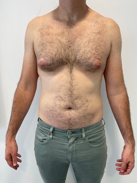 Male Liposuction of Flanks, Abdomen and Chest Wall — before, view 1
