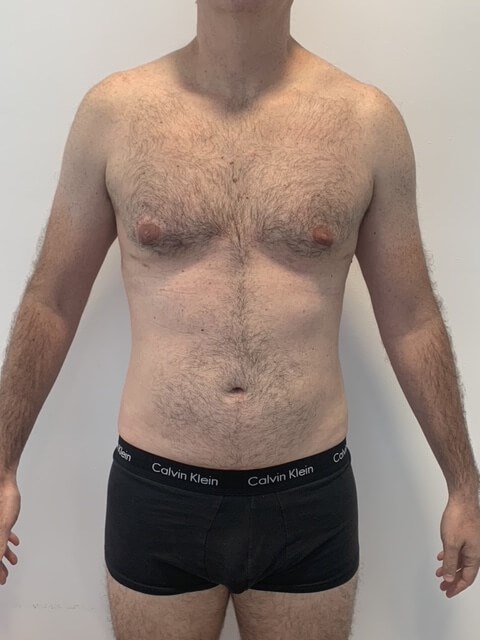 Male Liposuction of Flanks, Abdomen and Chest Wall — before, view 2