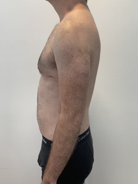 Male Liposuction of Flanks, Abdomen and Chest Wall — before, view 3
