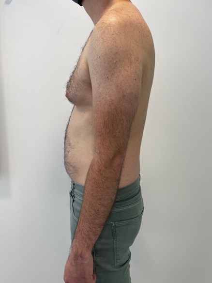 Male Liposuction of Flanks, Abdomen and Chest Wall — before, view 4