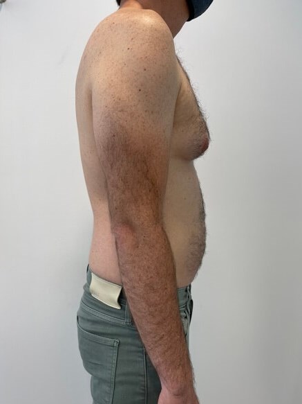 Male Liposuction of Flanks, Abdomen and Chest Wall — before, view 5