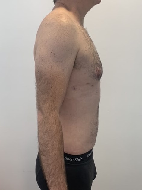 Male Liposuction of Flanks, Abdomen and Chest Wall — before, view 6