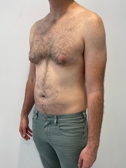 Male Liposuction of Flanks, Abdomen and Chest Wall