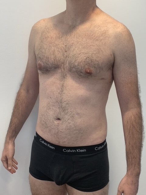 Male Liposuction of Flanks, Abdomen and Chest Wall — after, view 2