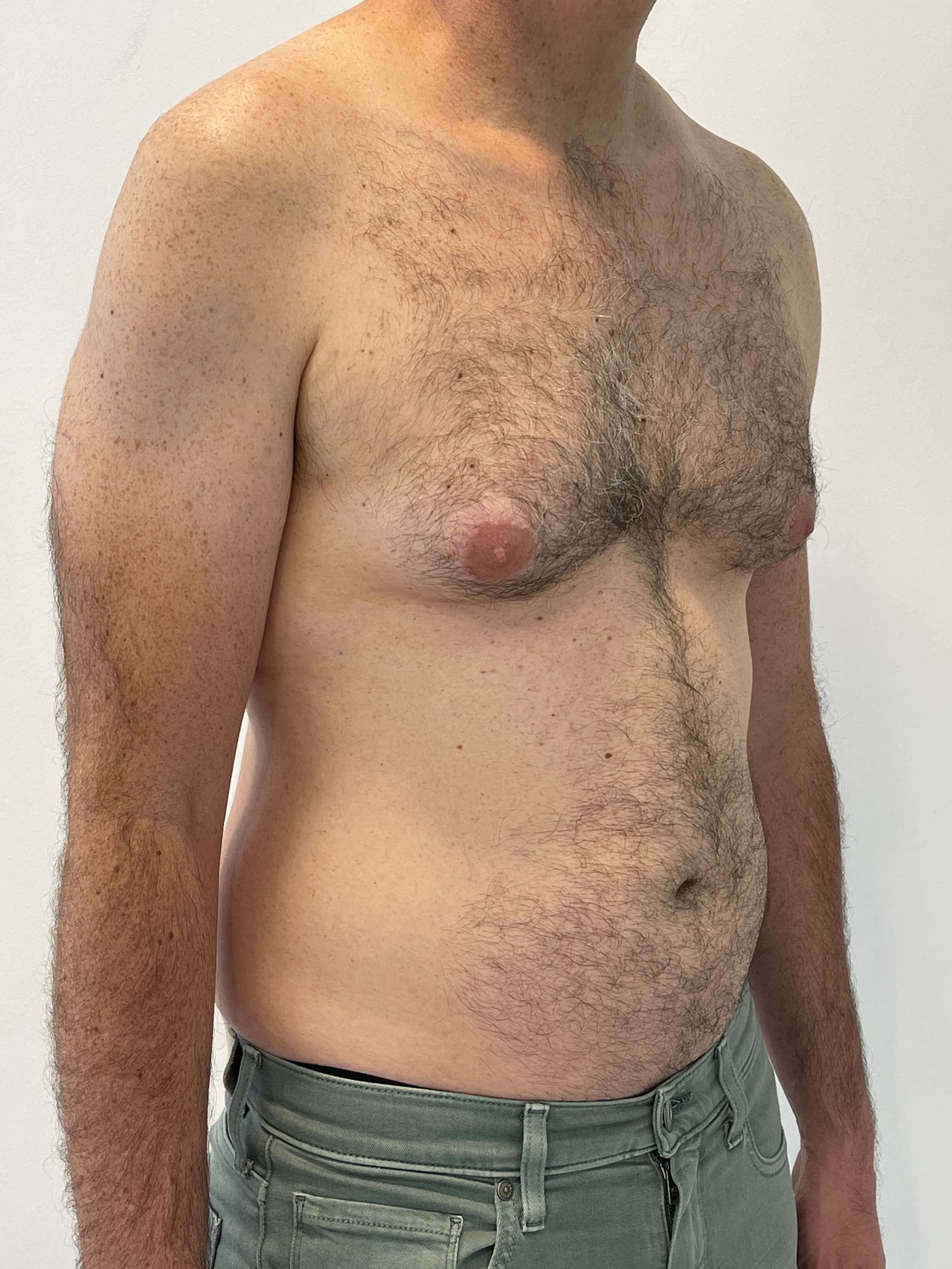 Male Liposuction of Flanks, Abdomen and Chest Wall — after, view 3