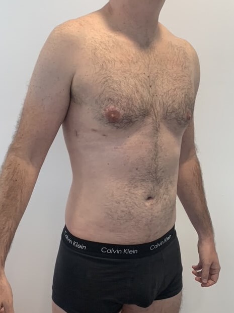Male Liposuction of Flanks, Abdomen and Chest Wall — after, view 4