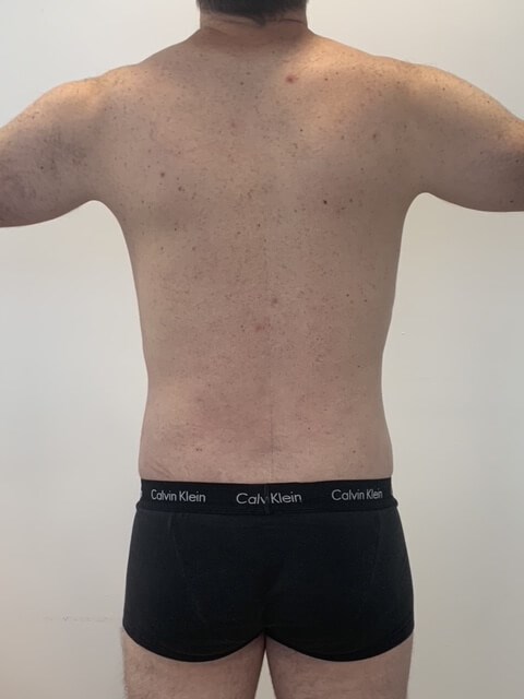 Male Liposuction of Flanks, Abdomen and Chest Wall — after, view 5