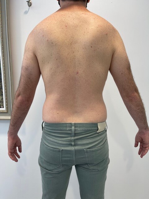 Male Liposuction of Flanks, Abdomen and Chest Wall — after, view 6