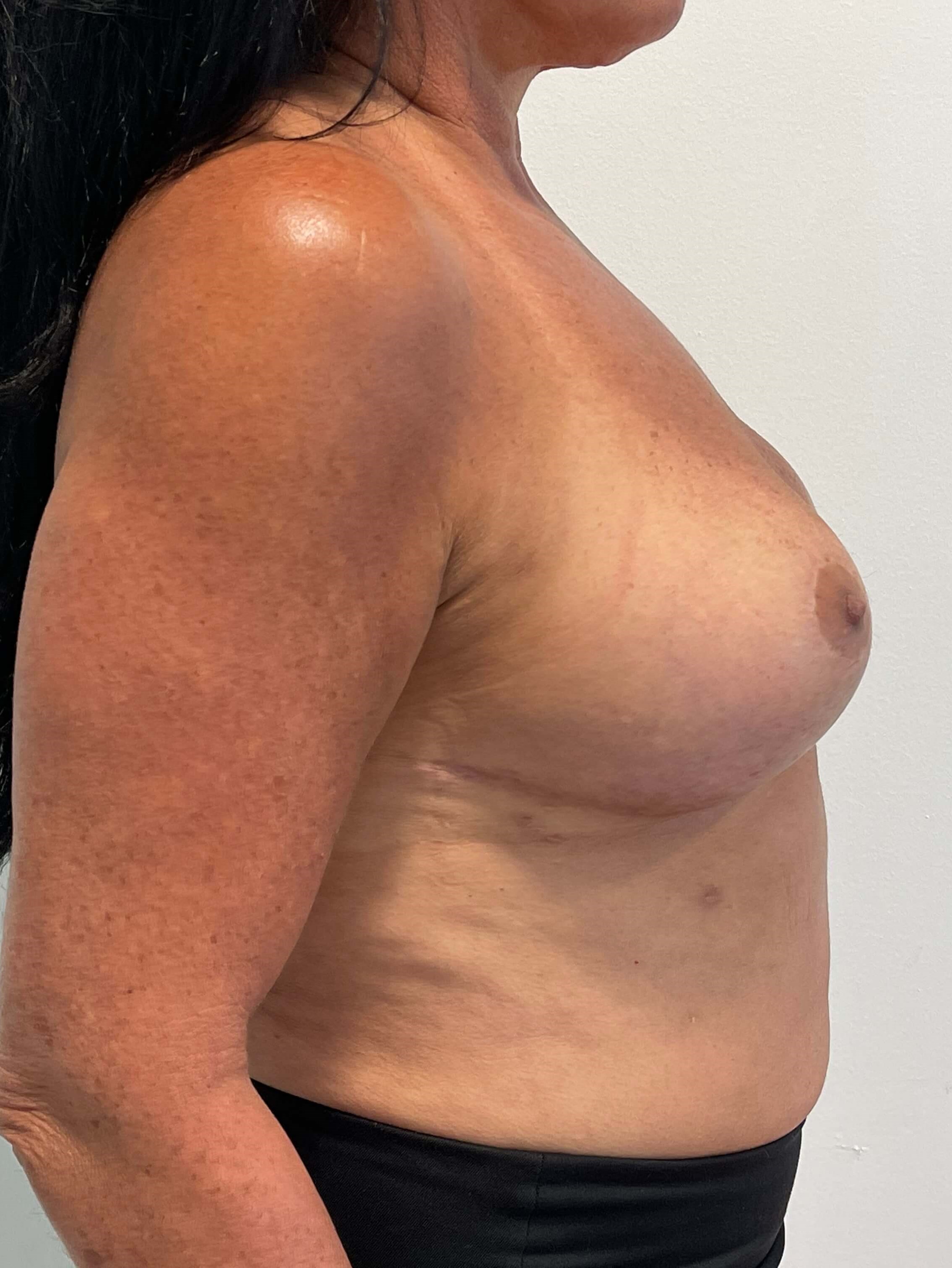 Breast Implant Removal and Replacement and Revision Breast Lift — after, view 2