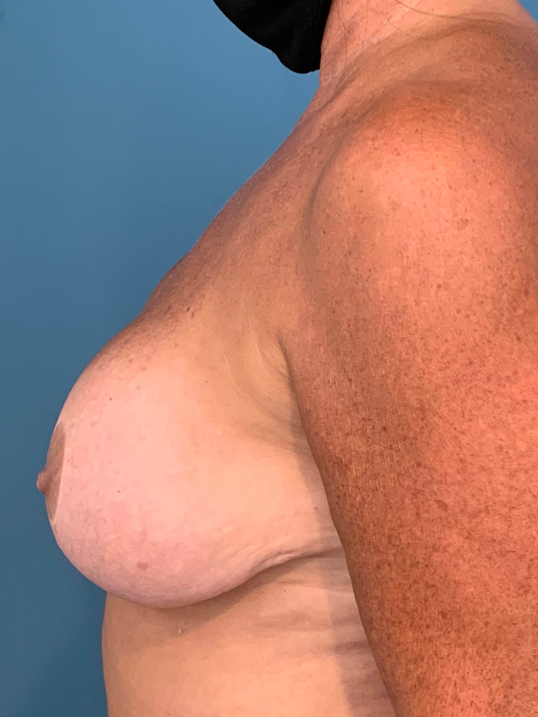 Breast Implant Removal and Replacement and Revision Breast Lift — before, view 3