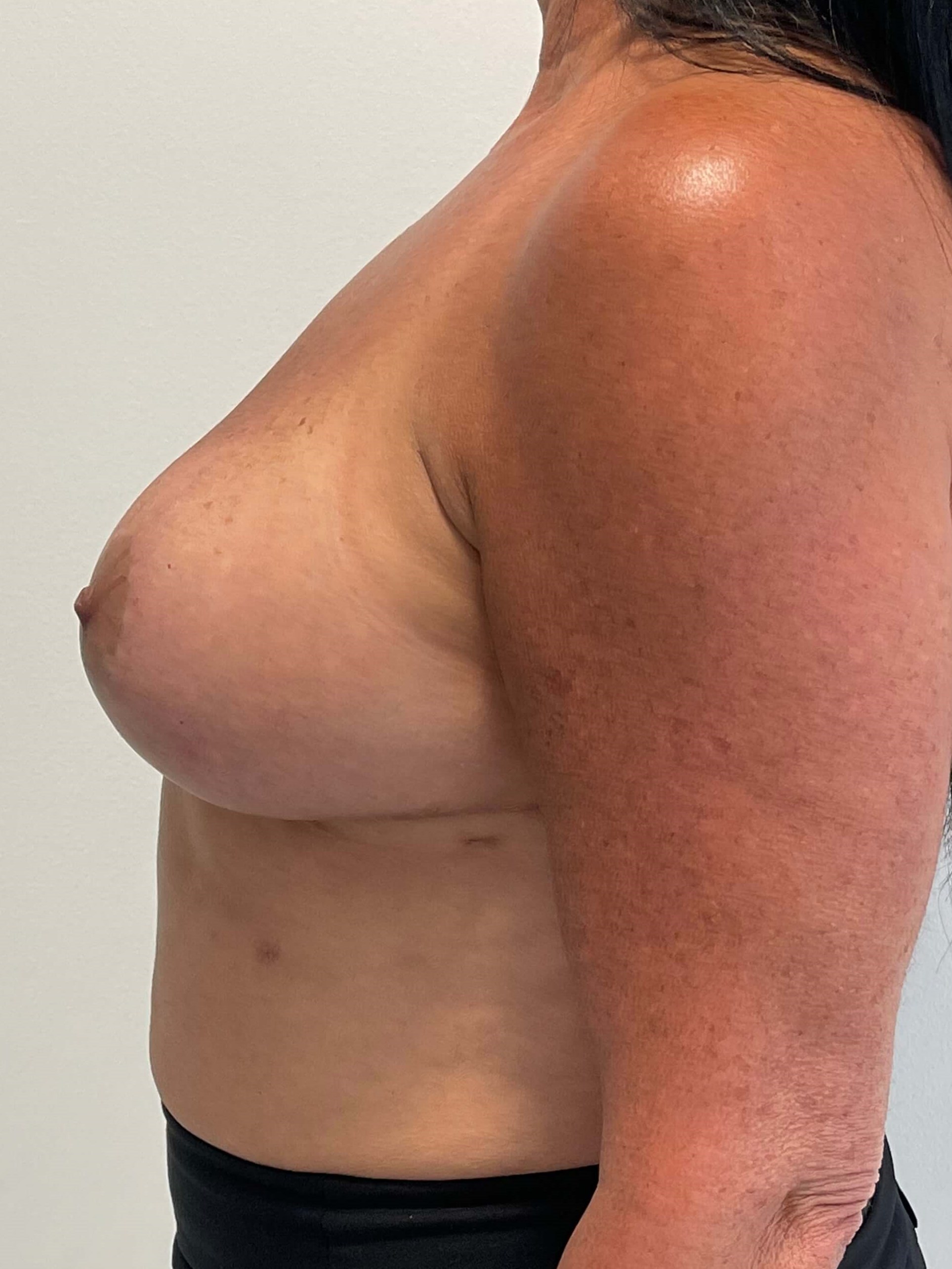 Breast Implant Removal and Replacement and Revision Breast Lift — after, view 3