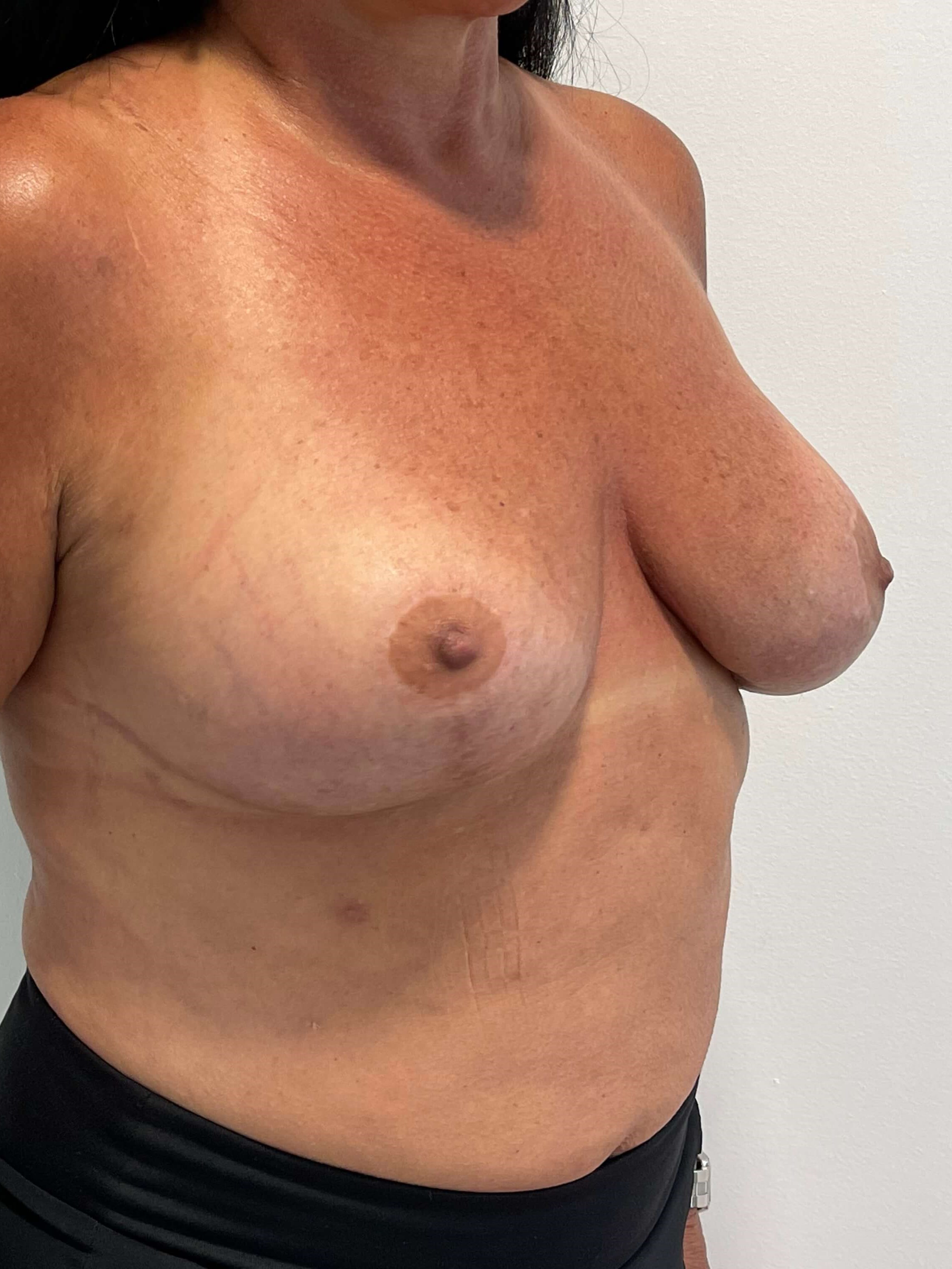 Breast Implant Removal and Replacement and Revision Breast Lift — after, view 4