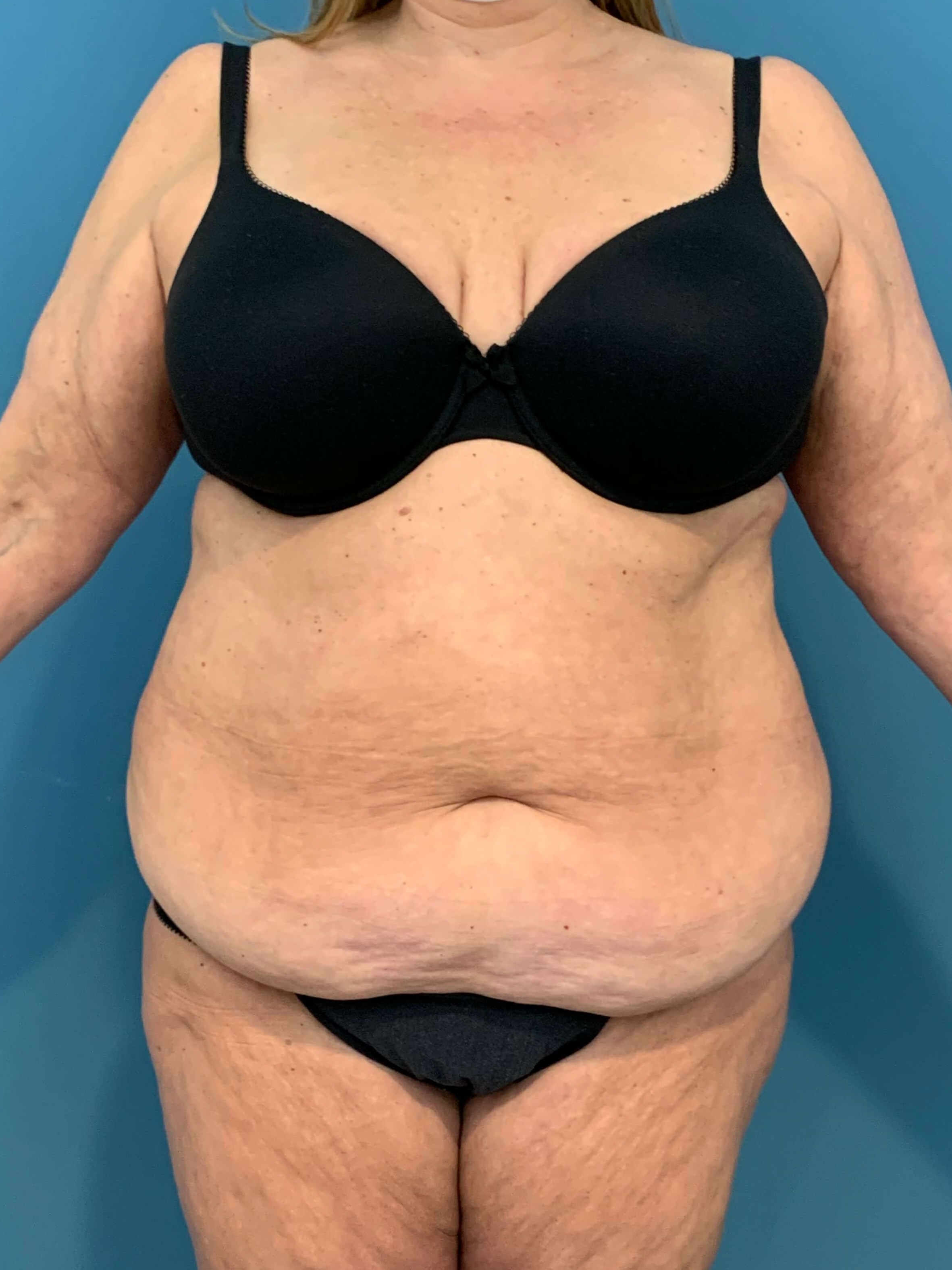 Abdominoplasty — before, view 1