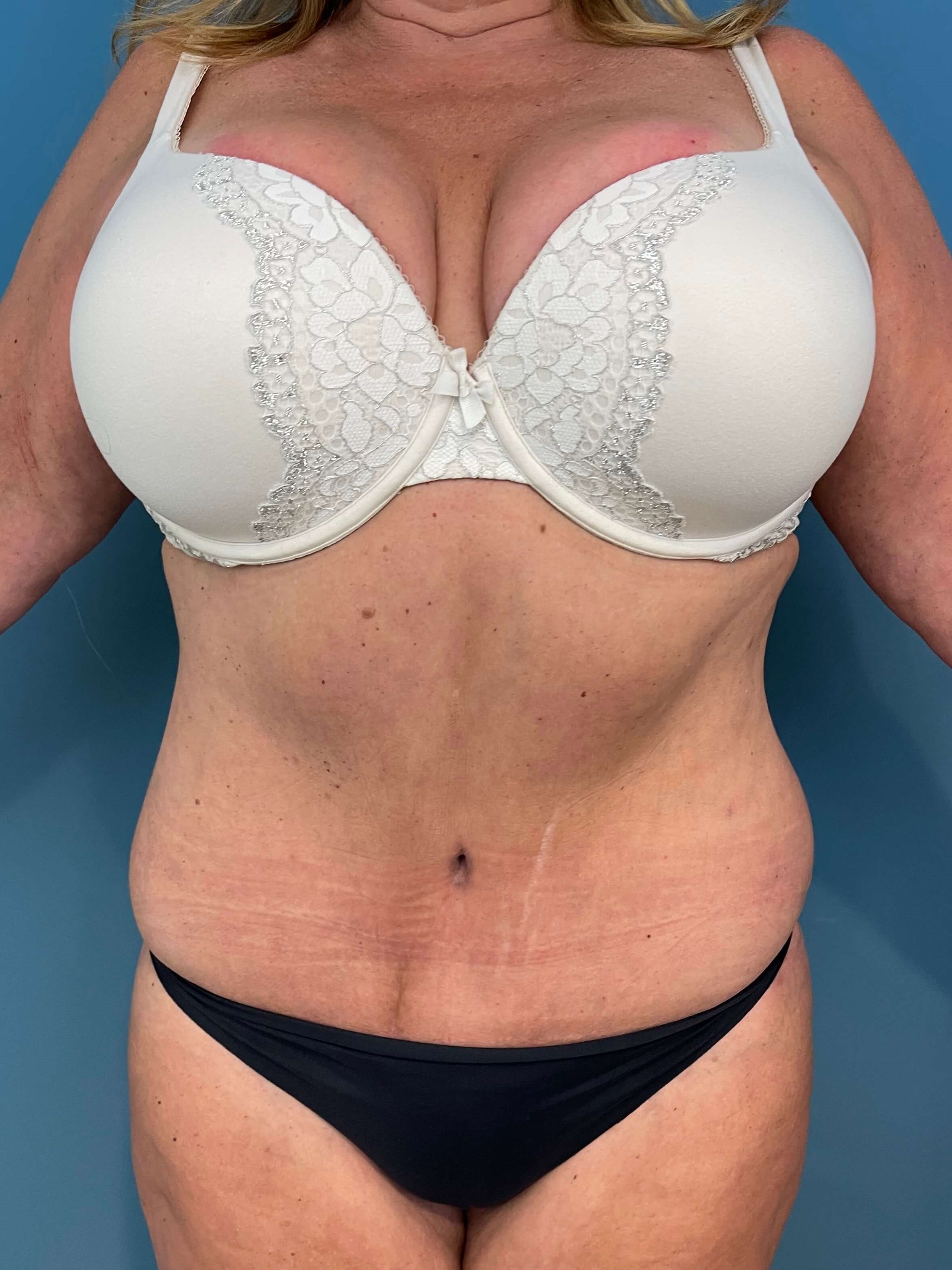 Abdominoplasty