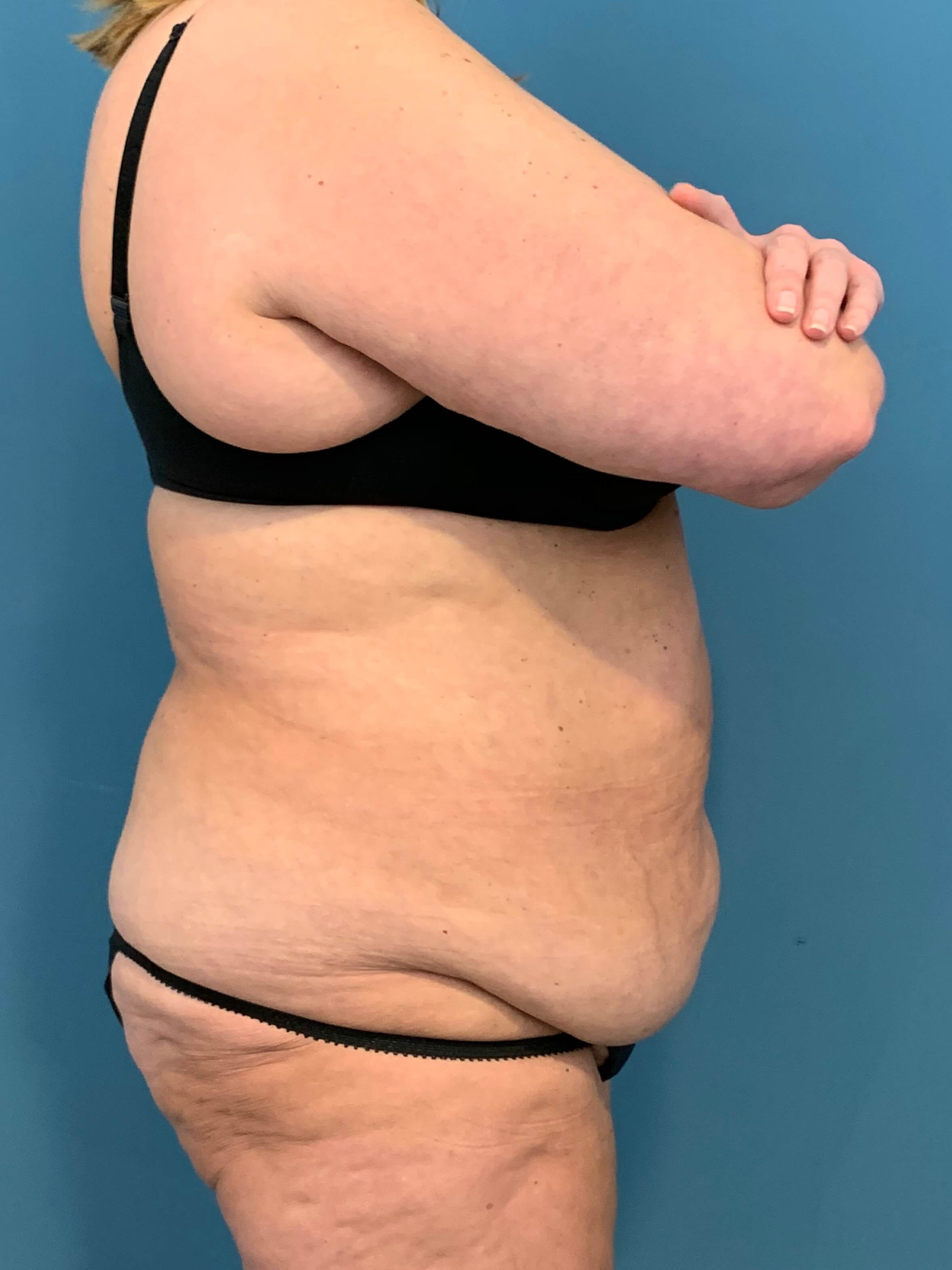 Abdominoplasty — before, view 2
