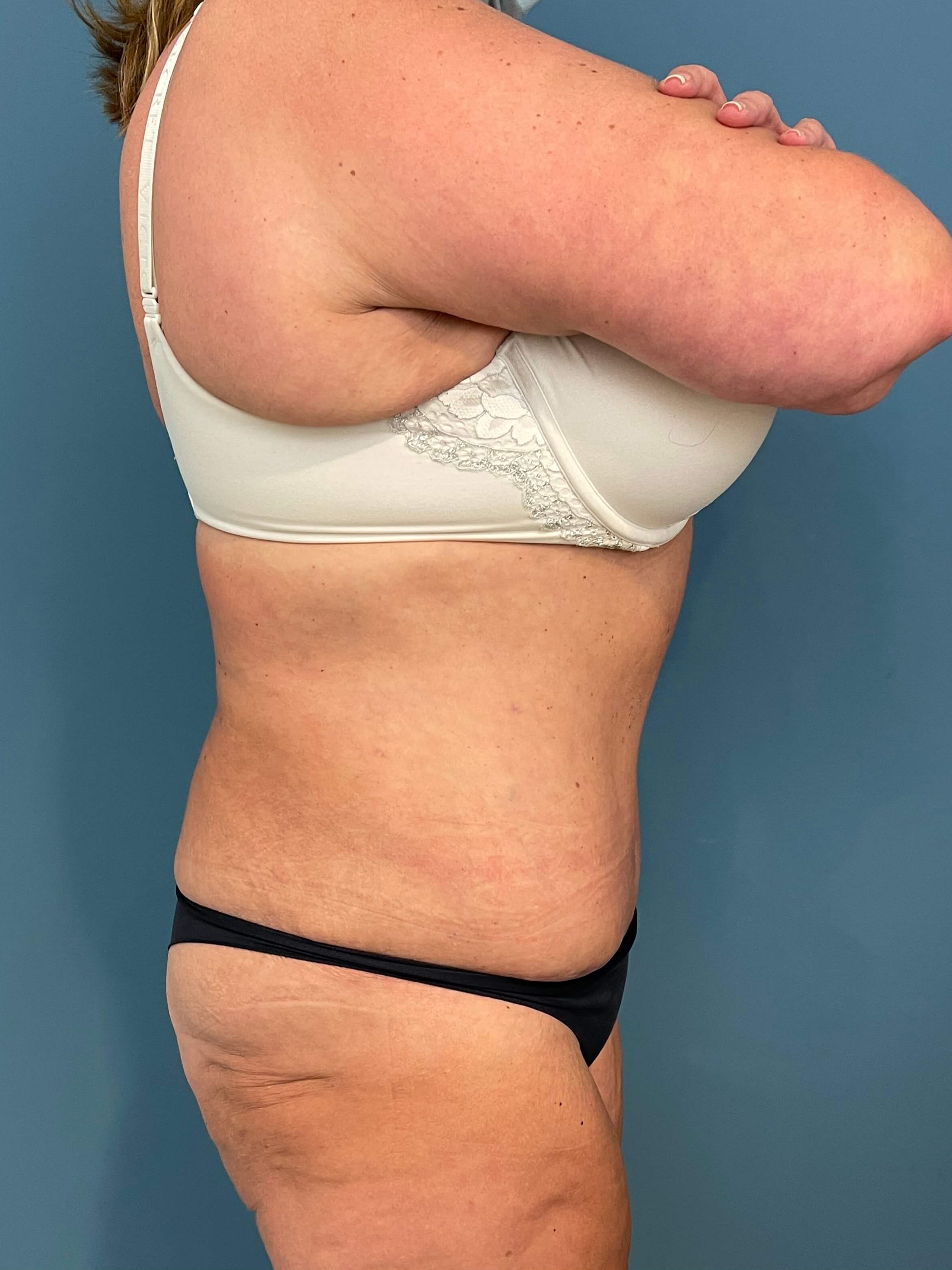 Abdominoplasty — after, view 2