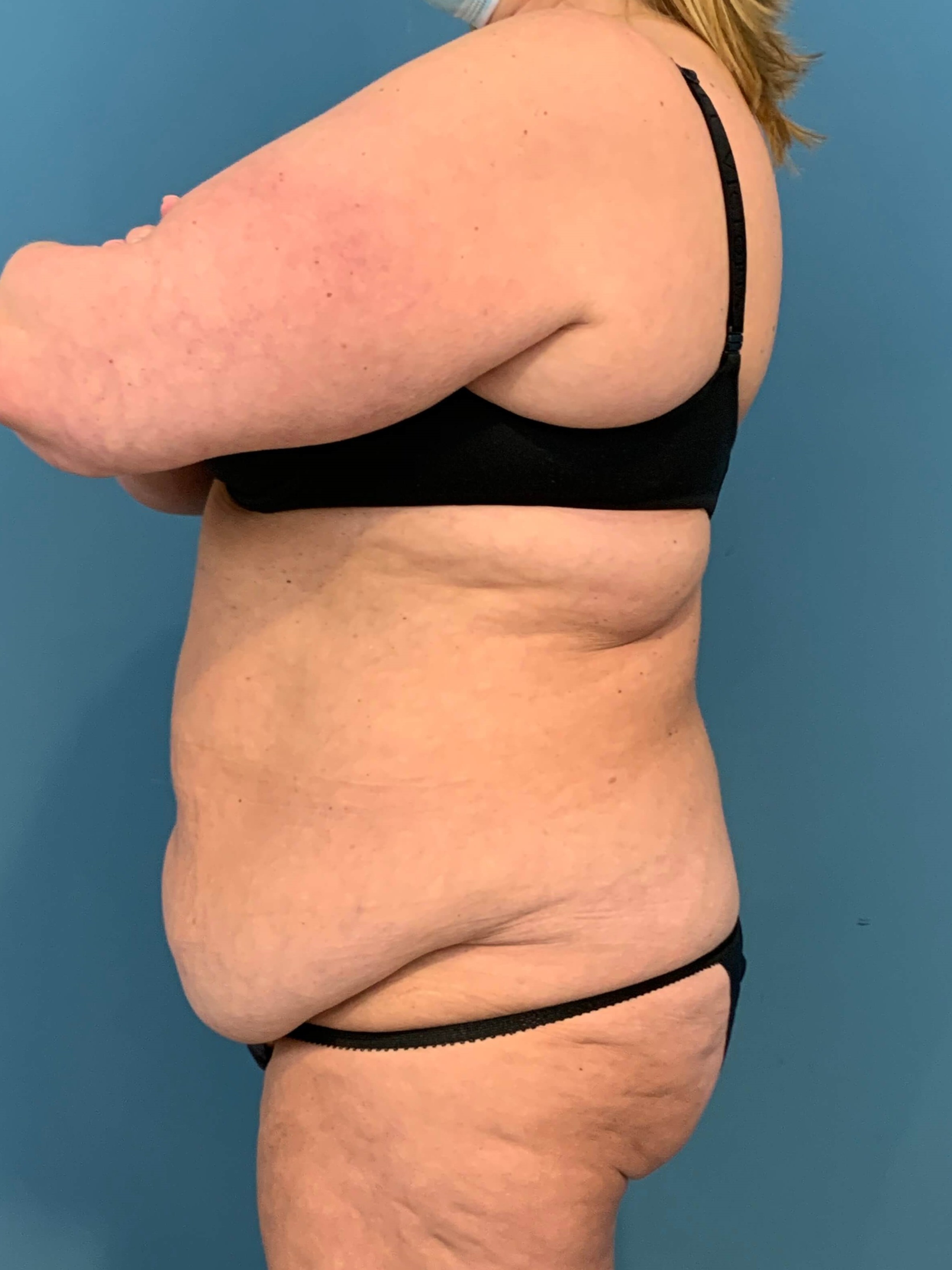 Abdominoplasty — before, view 3