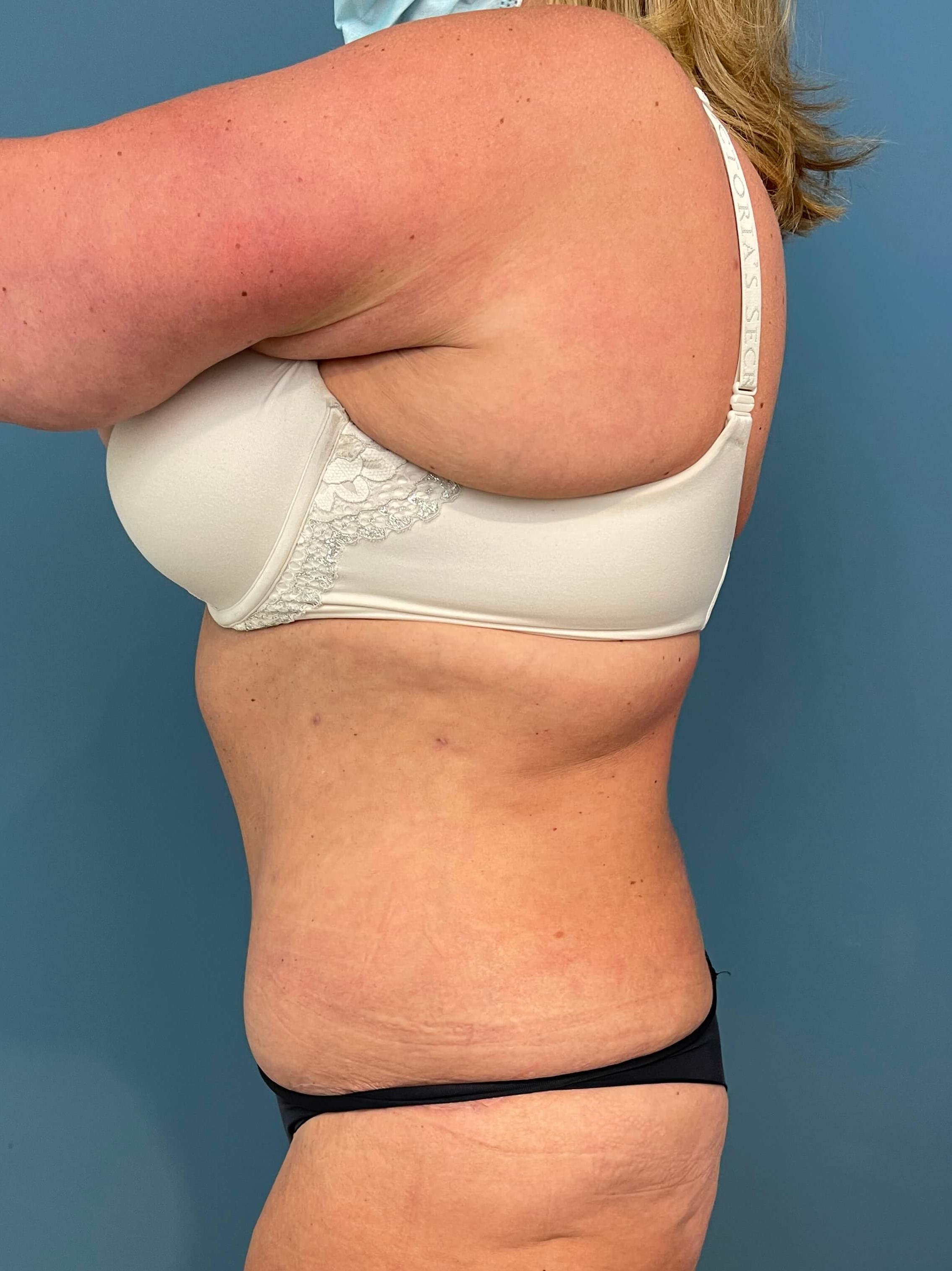 Abdominoplasty — after, view 3