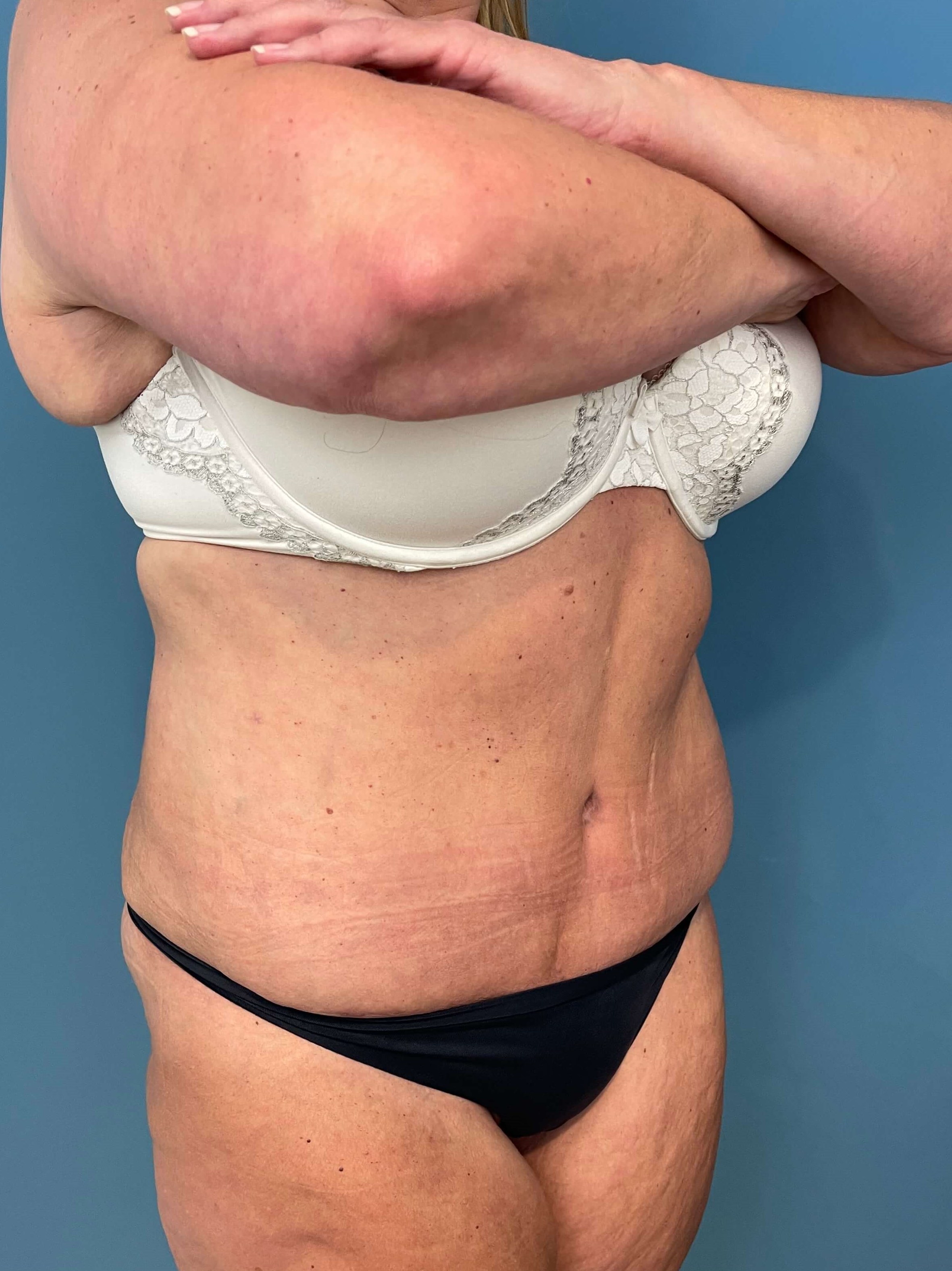 Abdominoplasty — after, view 4