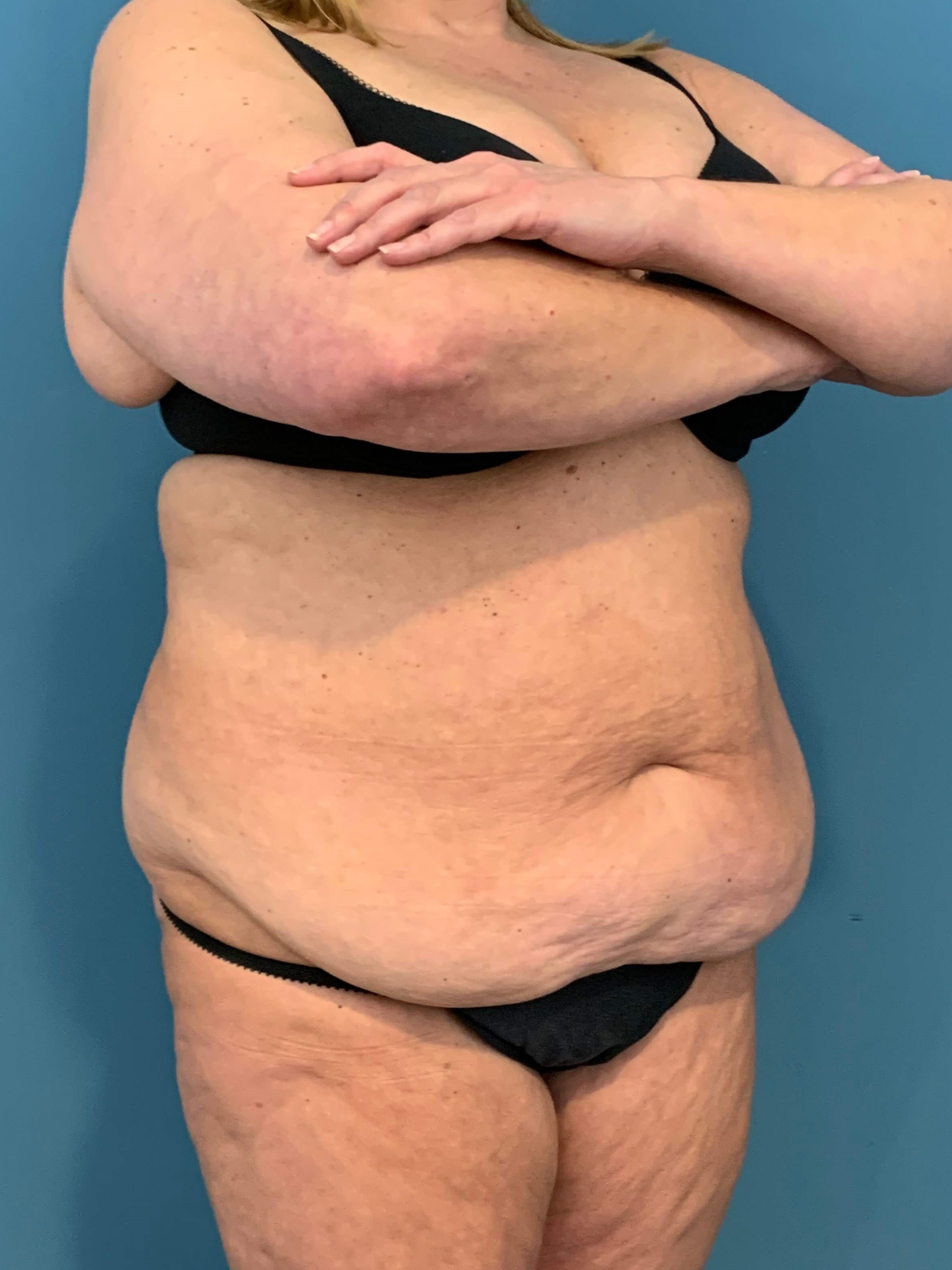 Abdominoplasty — before, view 4