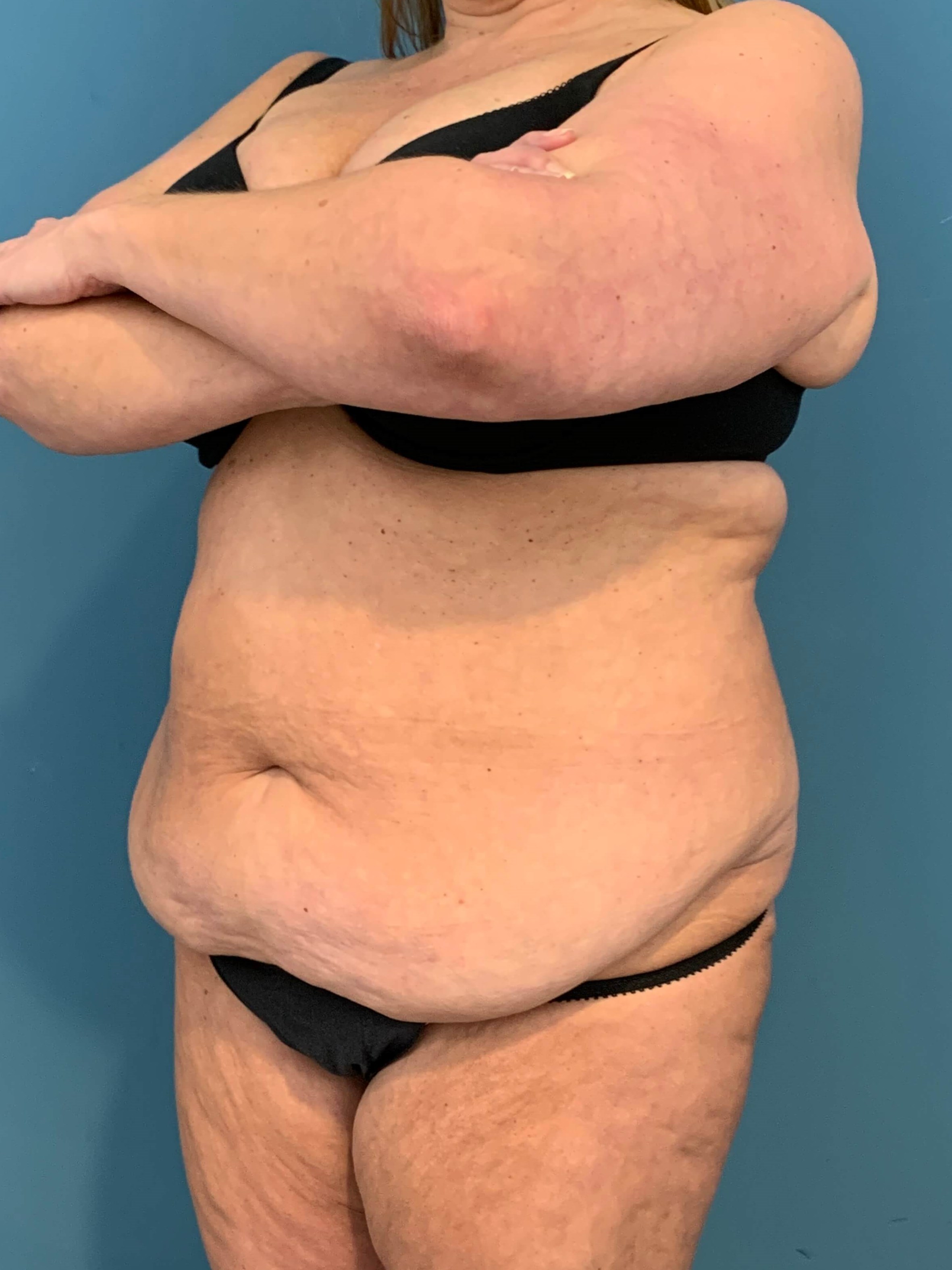Abdominoplasty — before, view 5