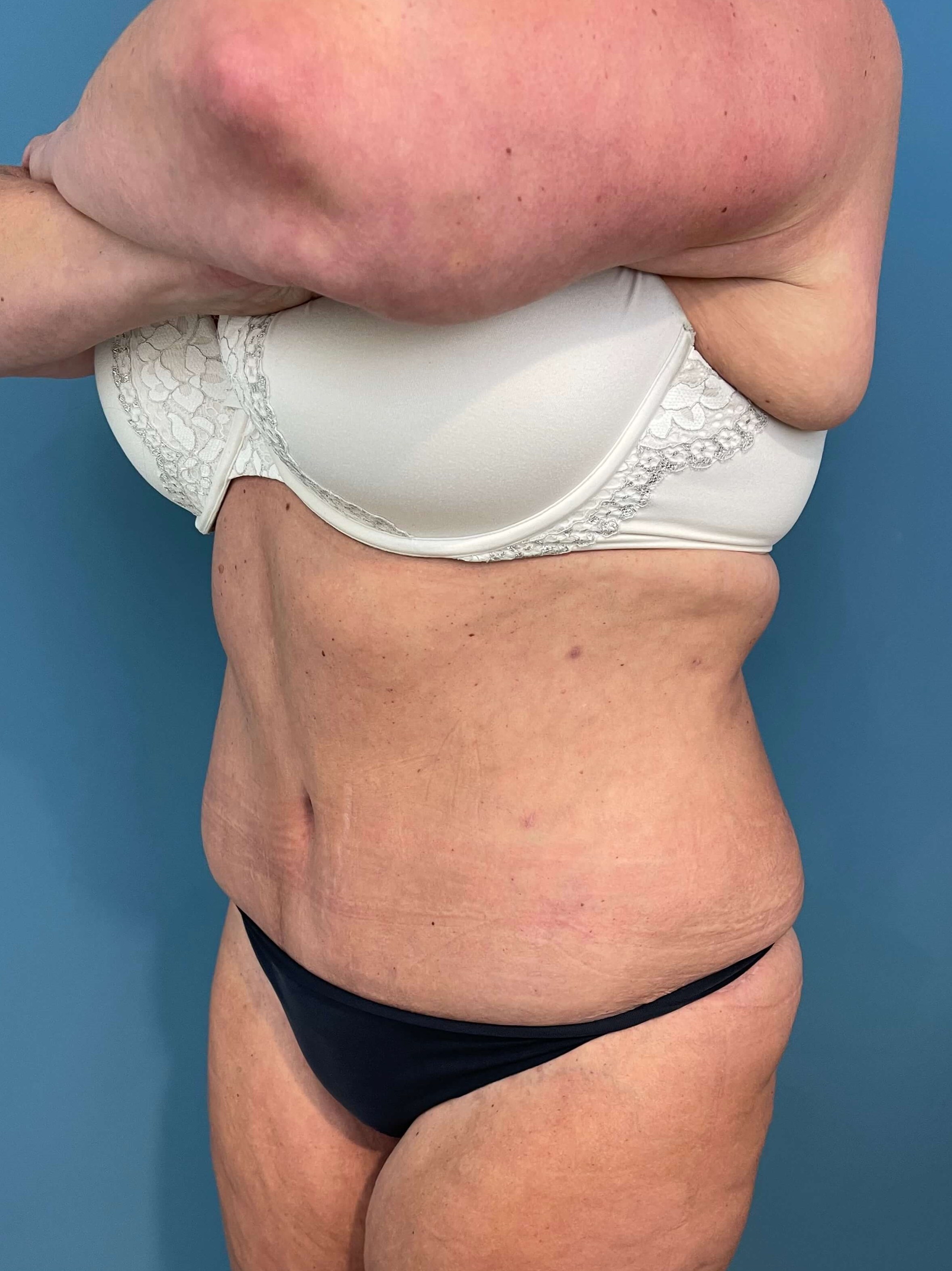 Abdominoplasty — after, view 5