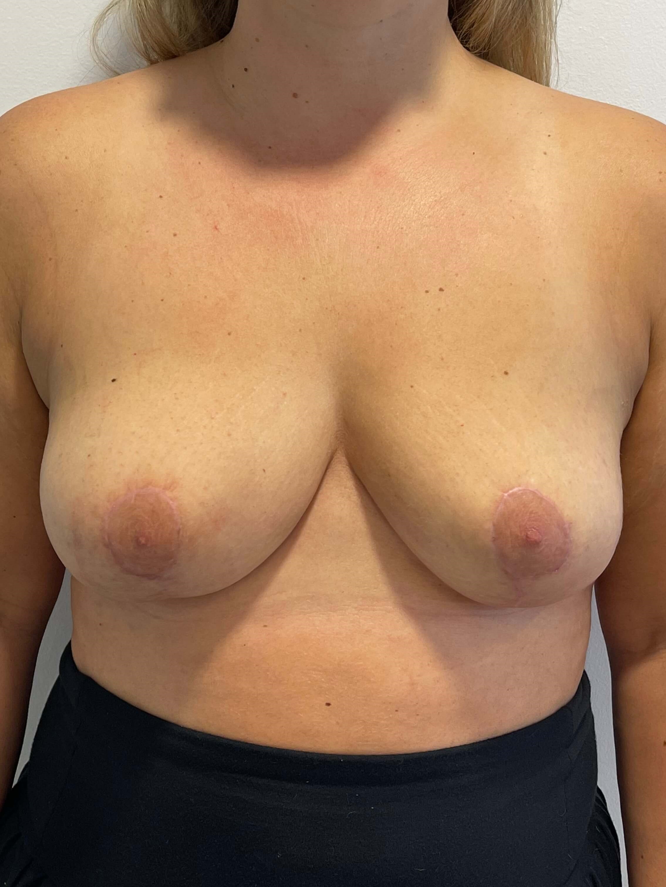 Bilateral Breast Implant Removal & Mastopexy