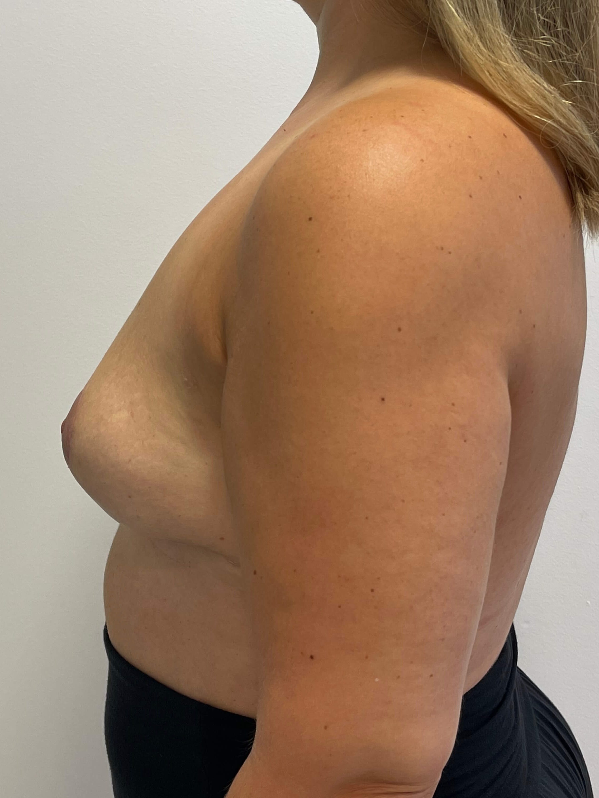 Bilateral Breast Implant Removal & Mastopexy — after, view 2