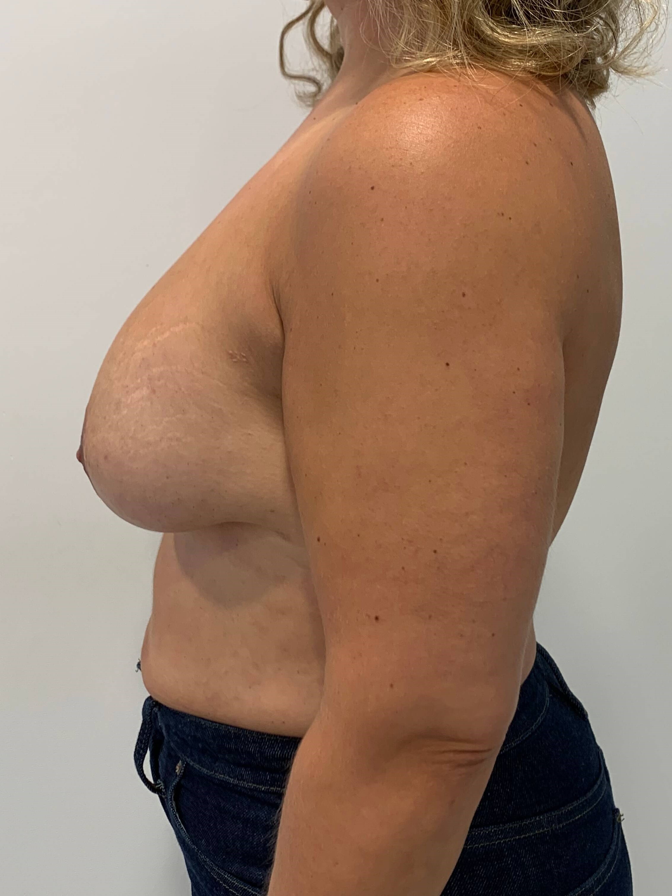 Bilateral Breast Implant Removal & Mastopexy — before, view 2