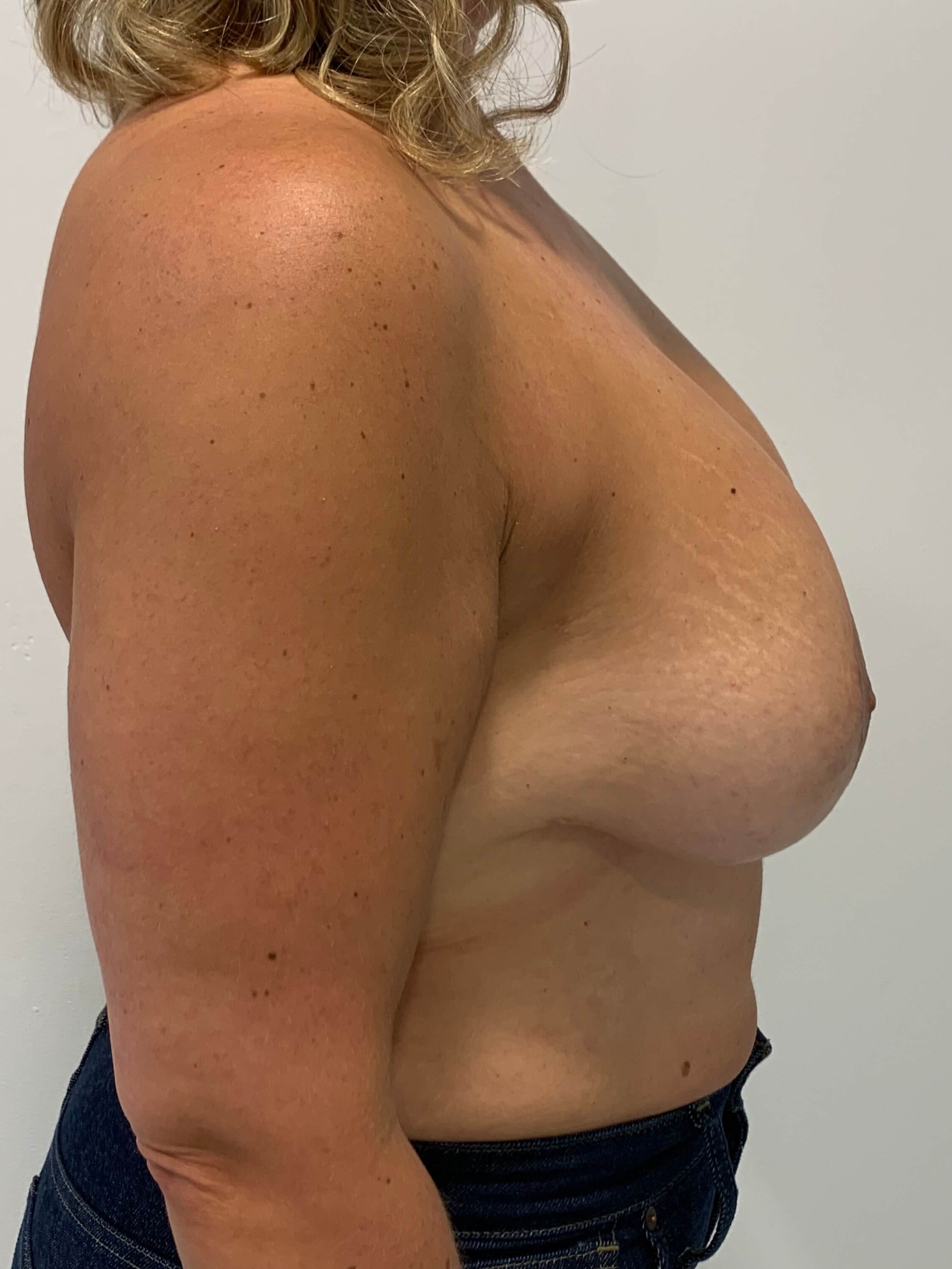 Bilateral Breast Implant Removal & Mastopexy — before, view 3