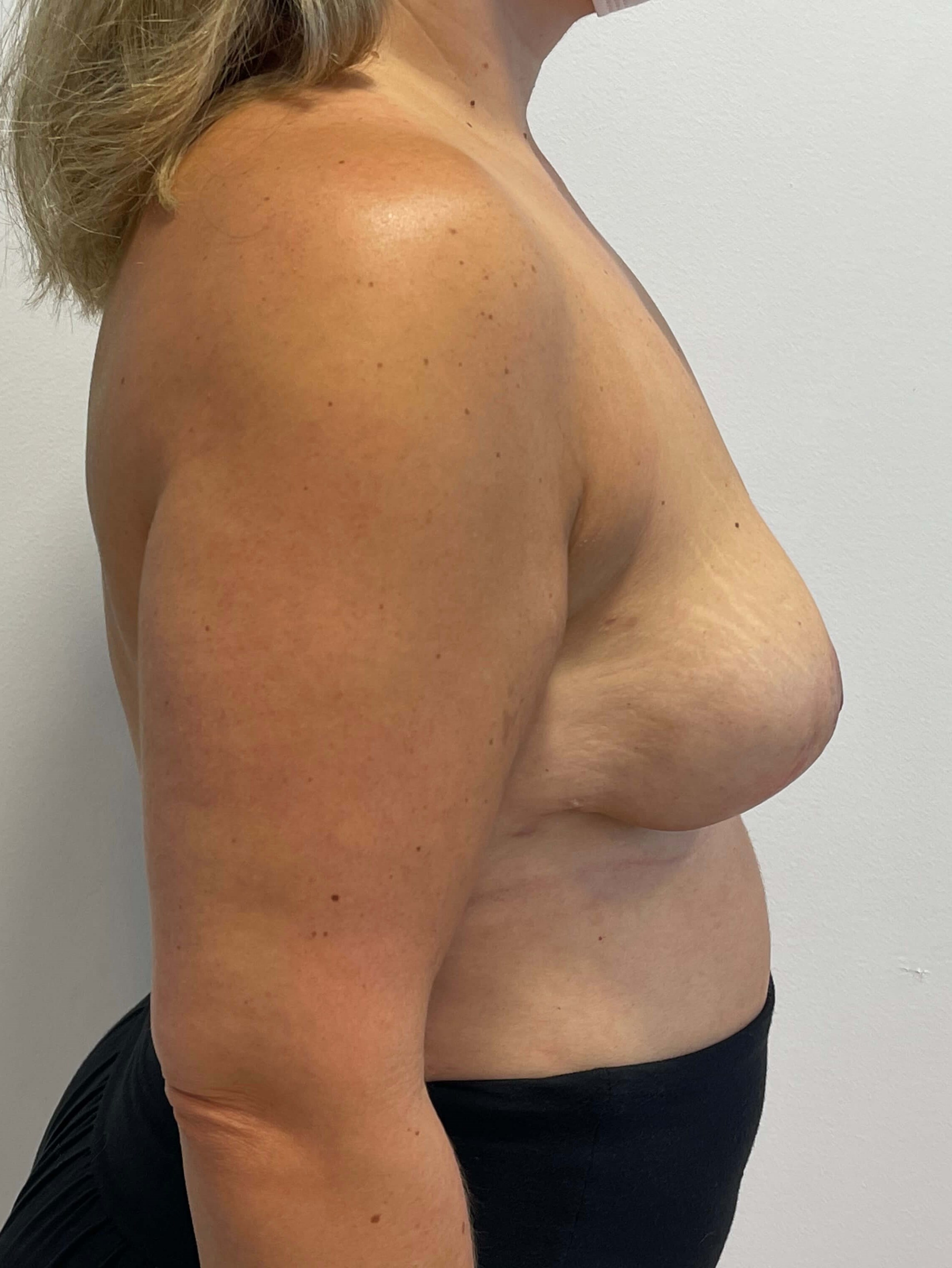 Bilateral Breast Implant Removal & Mastopexy — after, view 3