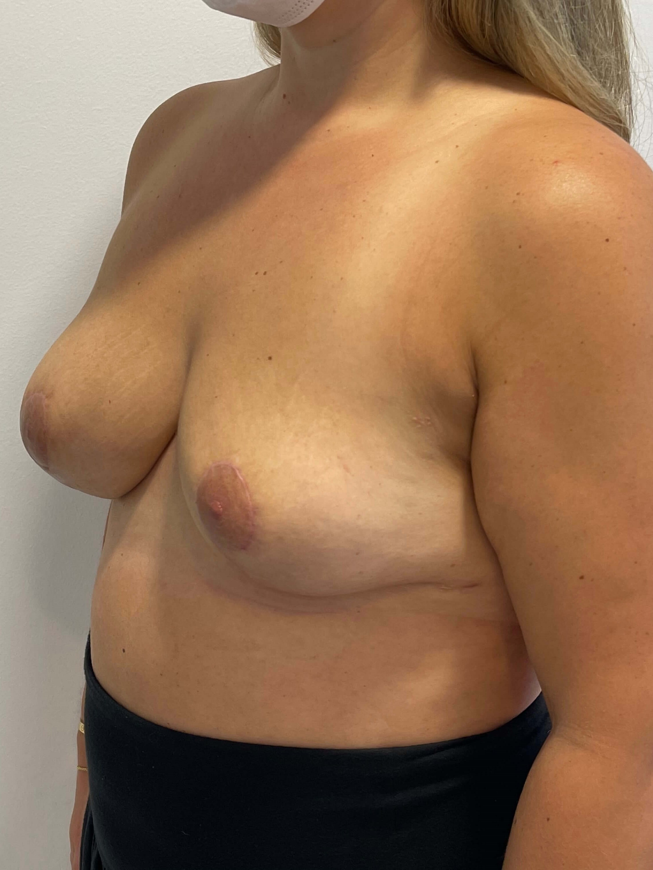 Bilateral Breast Implant Removal & Mastopexy — after, view 4