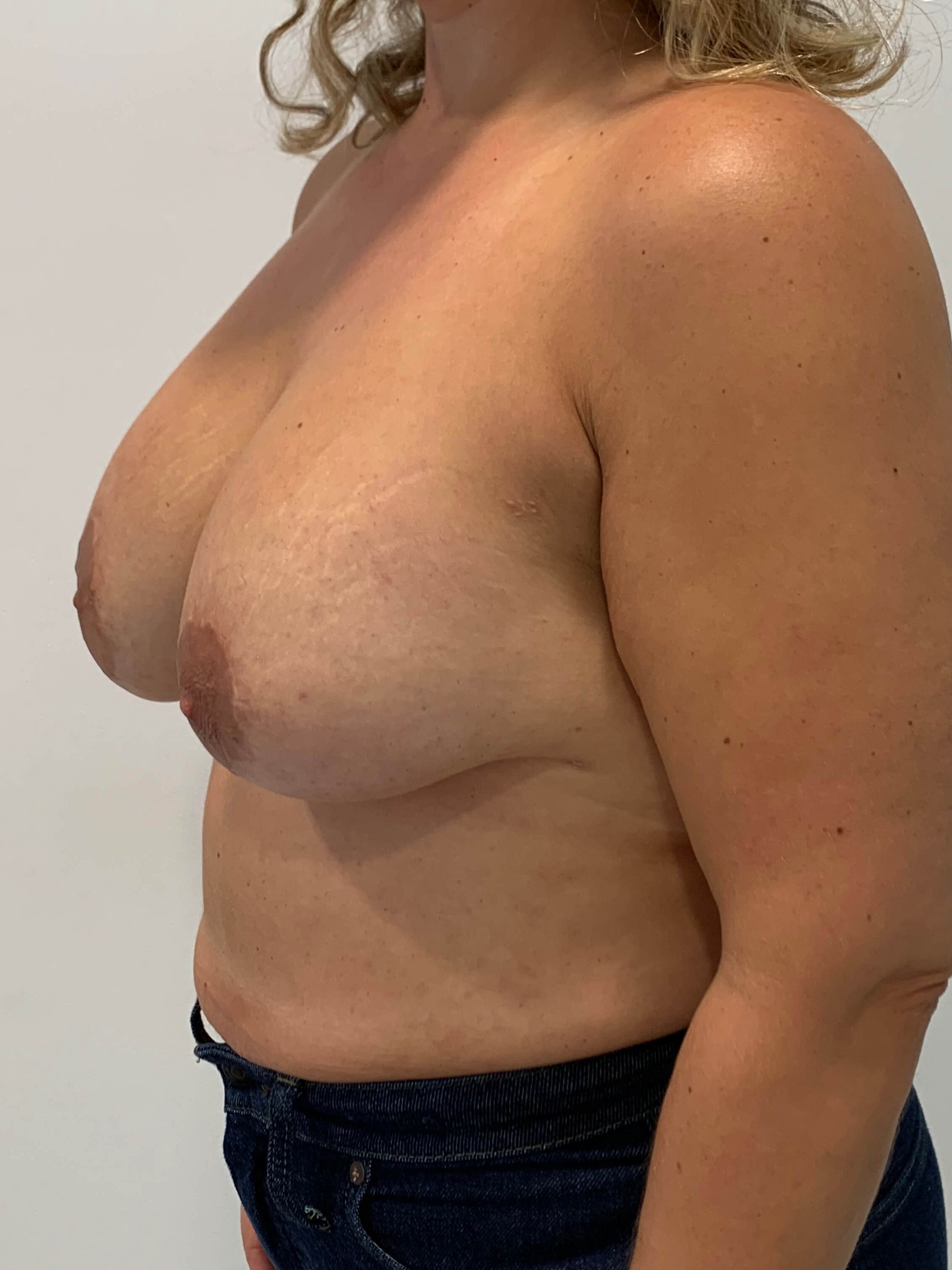 Bilateral Breast Implant Removal & Mastopexy — before, view 4