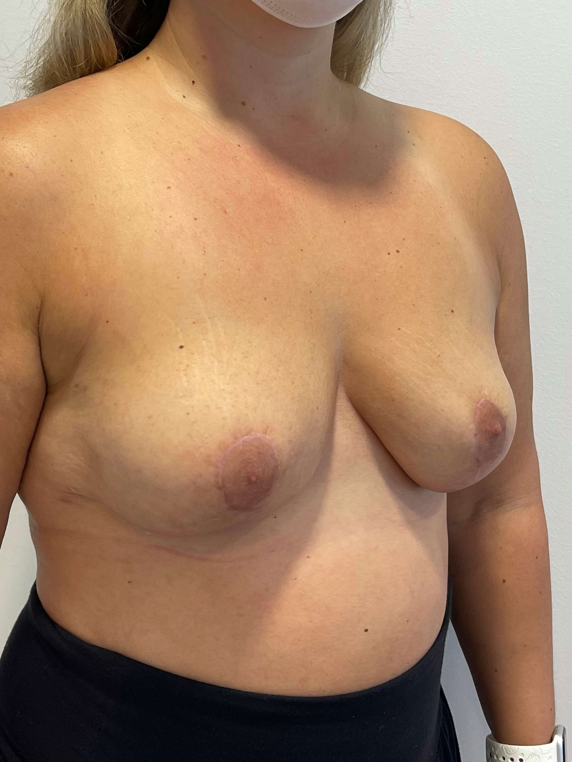 Bilateral Breast Implant Removal & Mastopexy — after, view 5