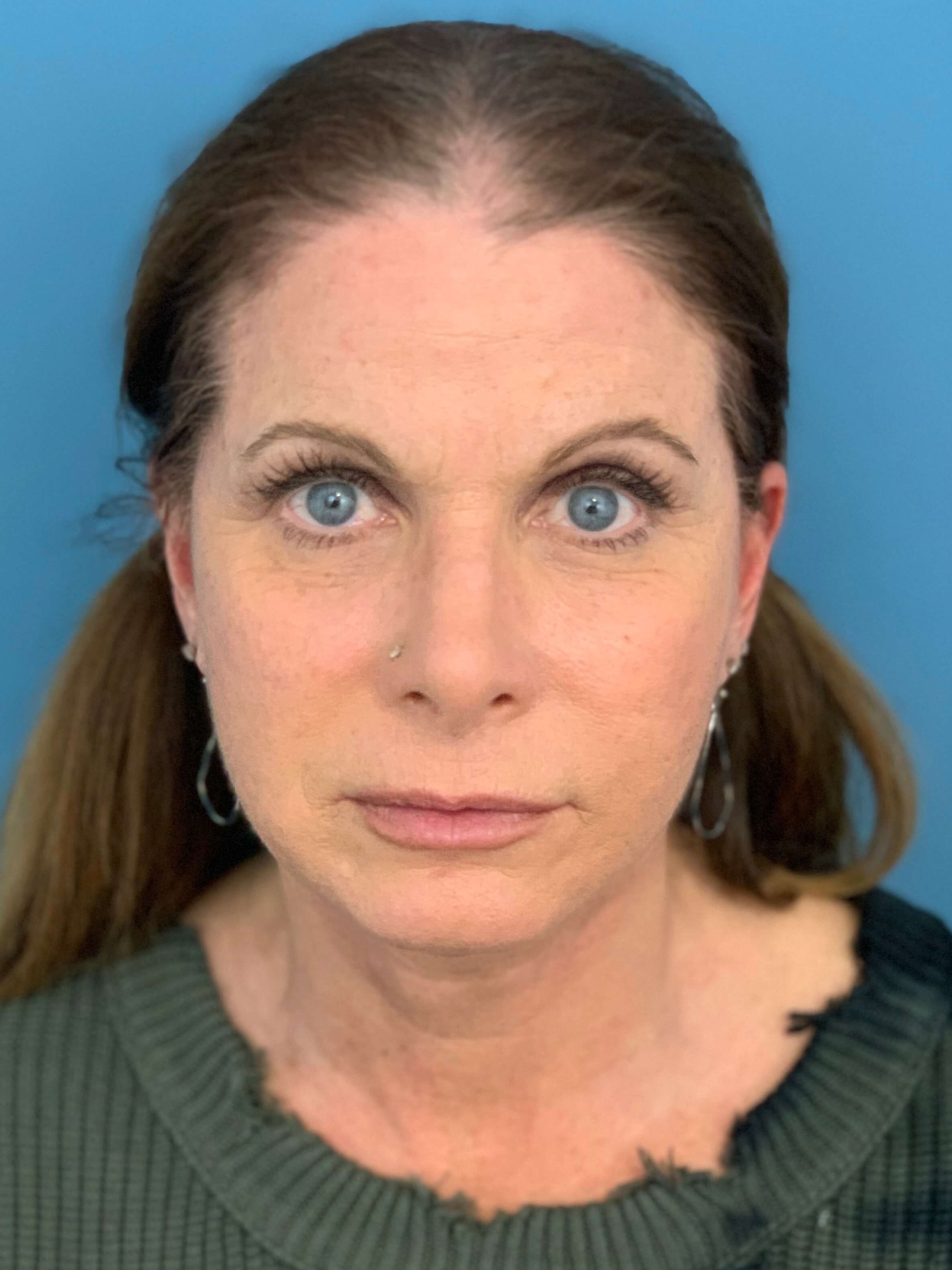 Deep Plane Lower Face and Neck Lift