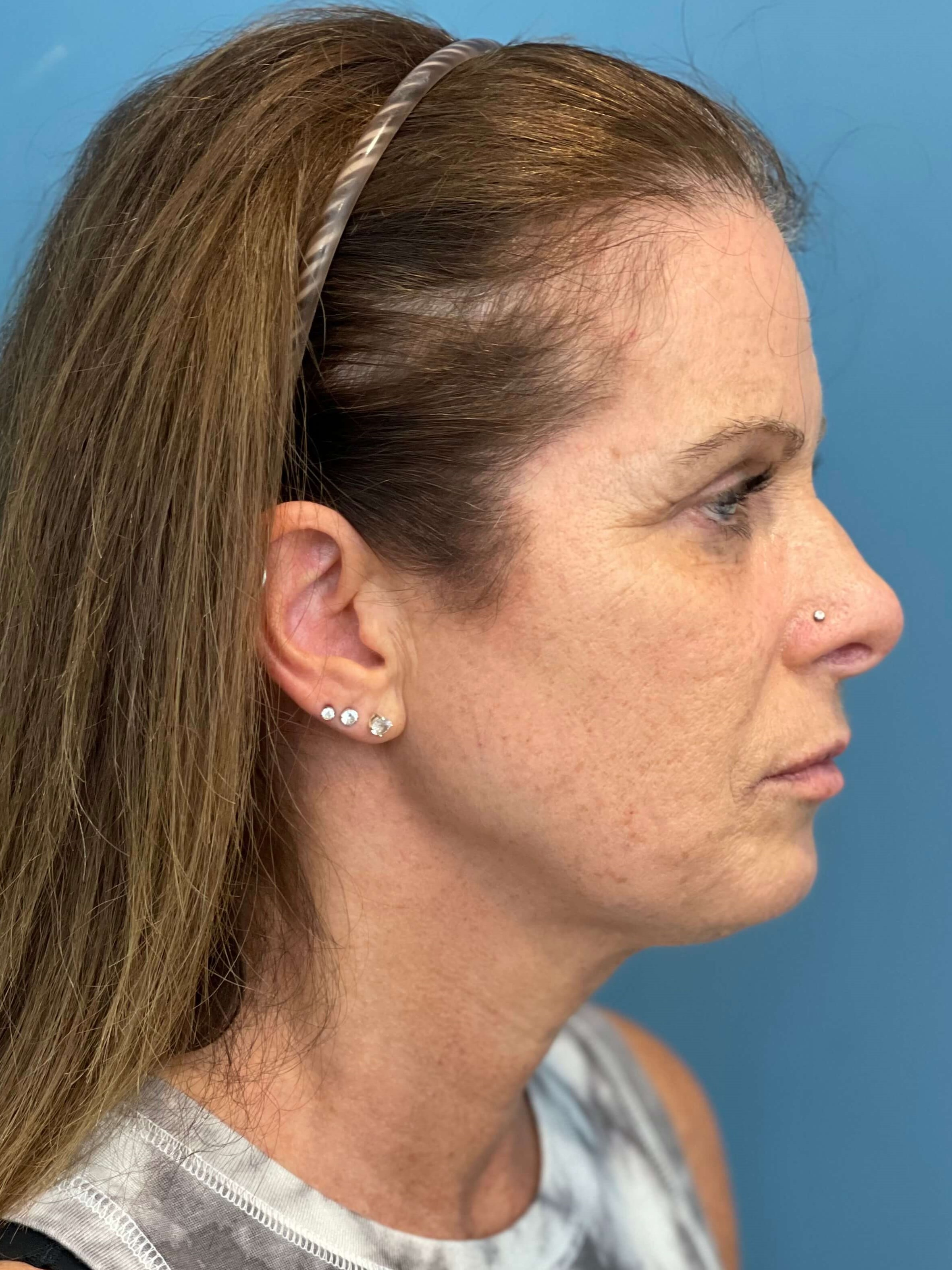 Deep Plane Lower Face and Neck Lift — before, view 2