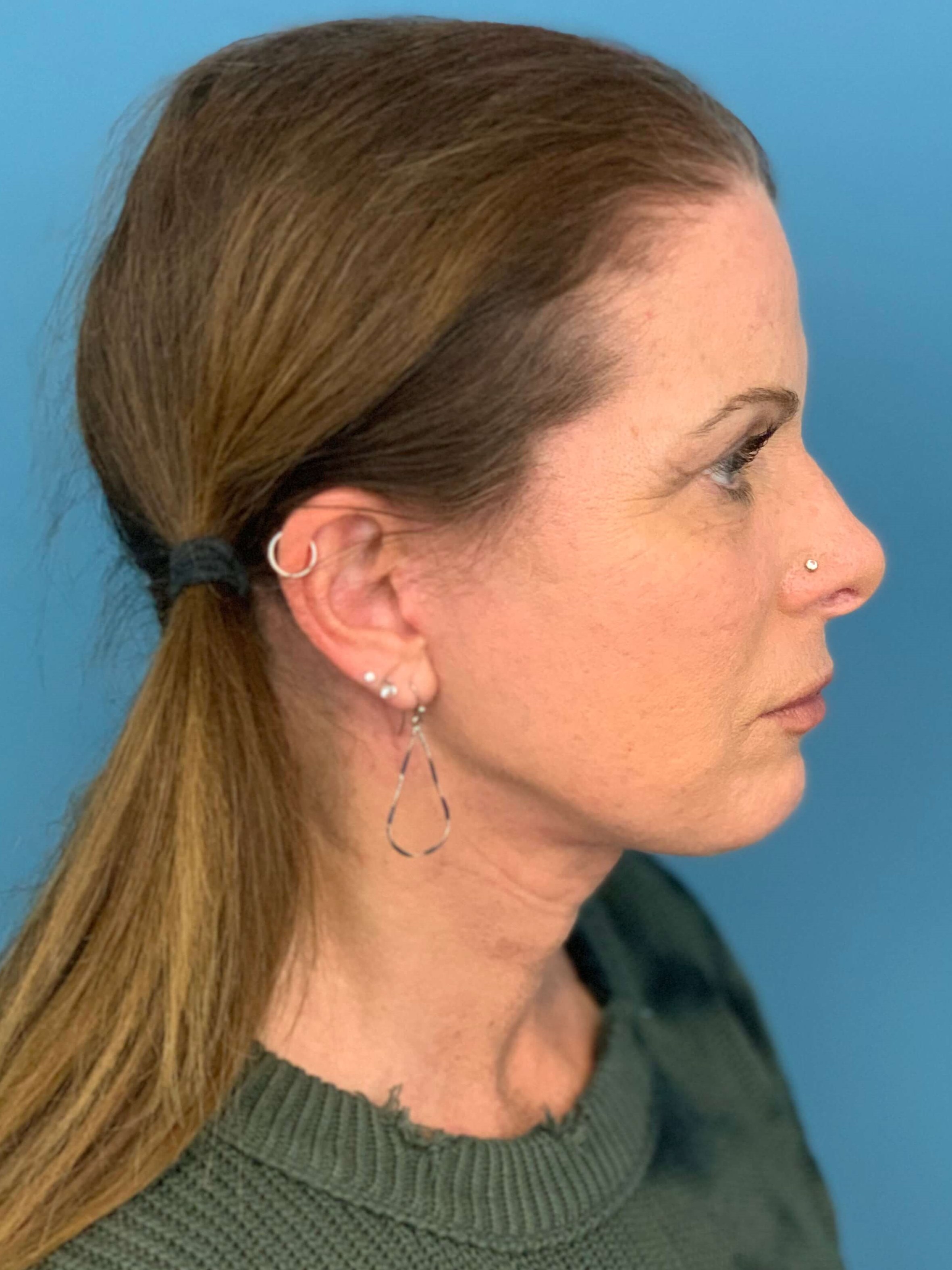 Deep Plane Lower Face and Neck Lift — after, view 2