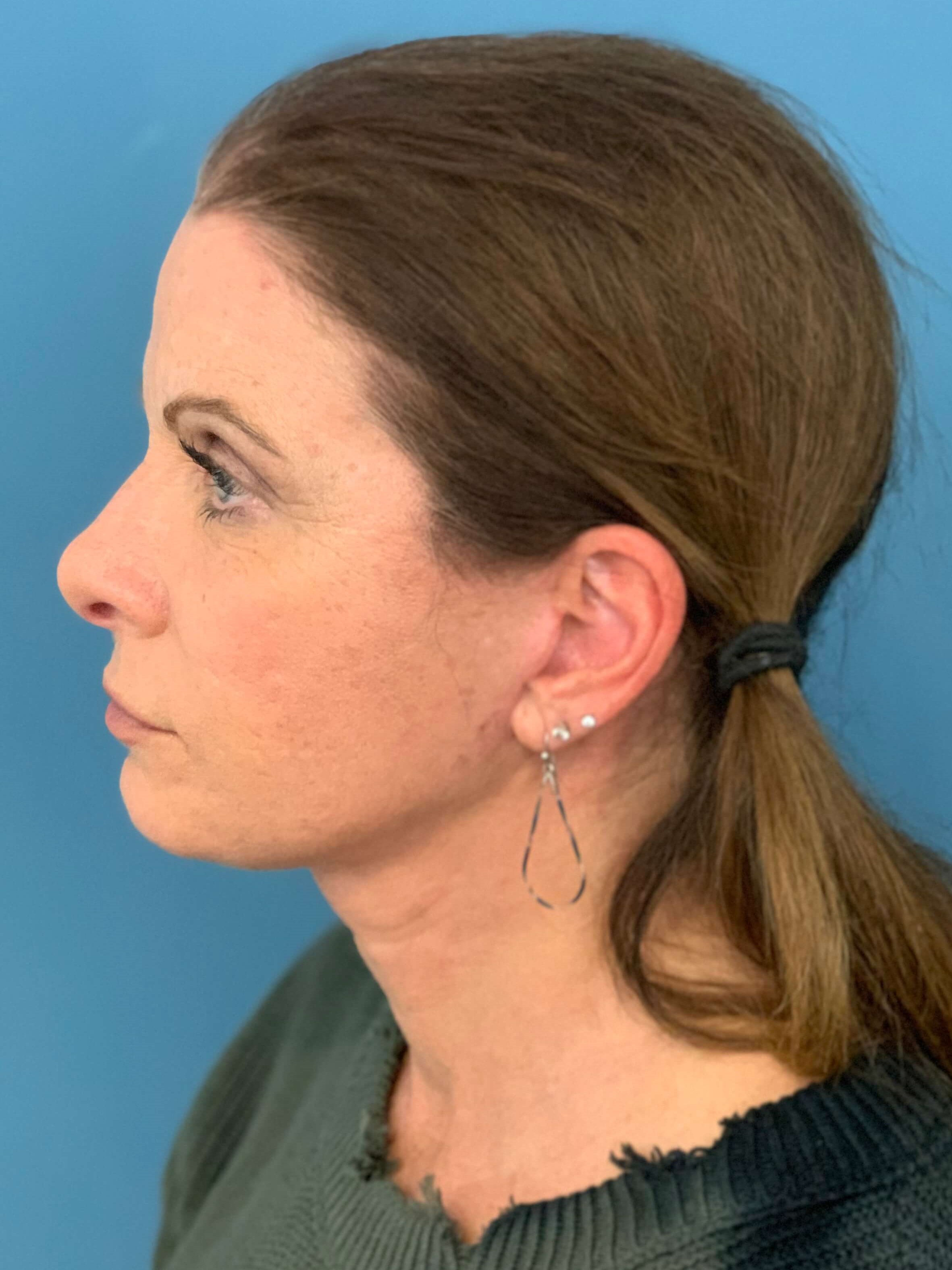 Deep Plane Lower Face and Neck Lift — after, view 3