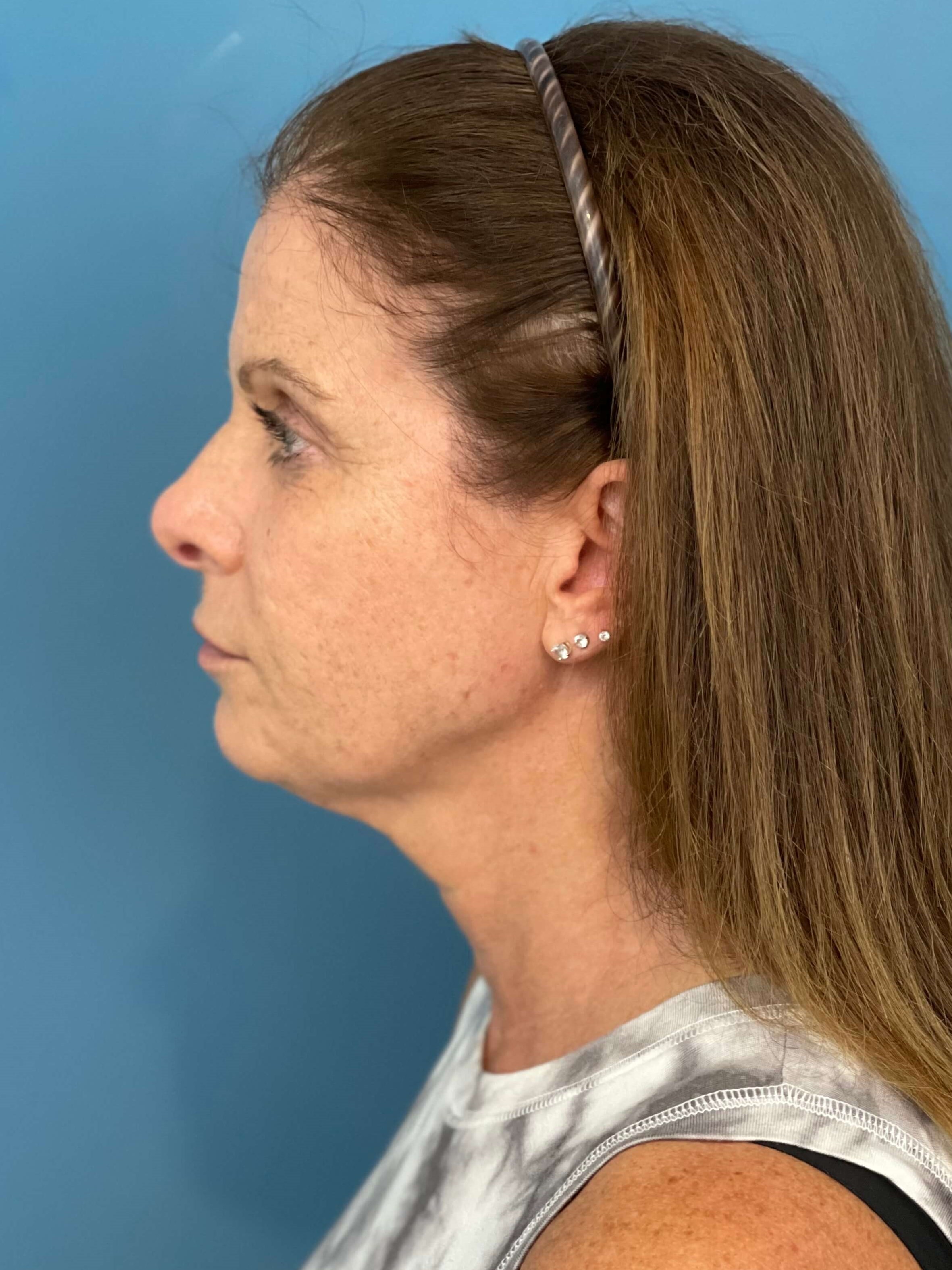 Deep Plane Lower Face and Neck Lift — before, view 3