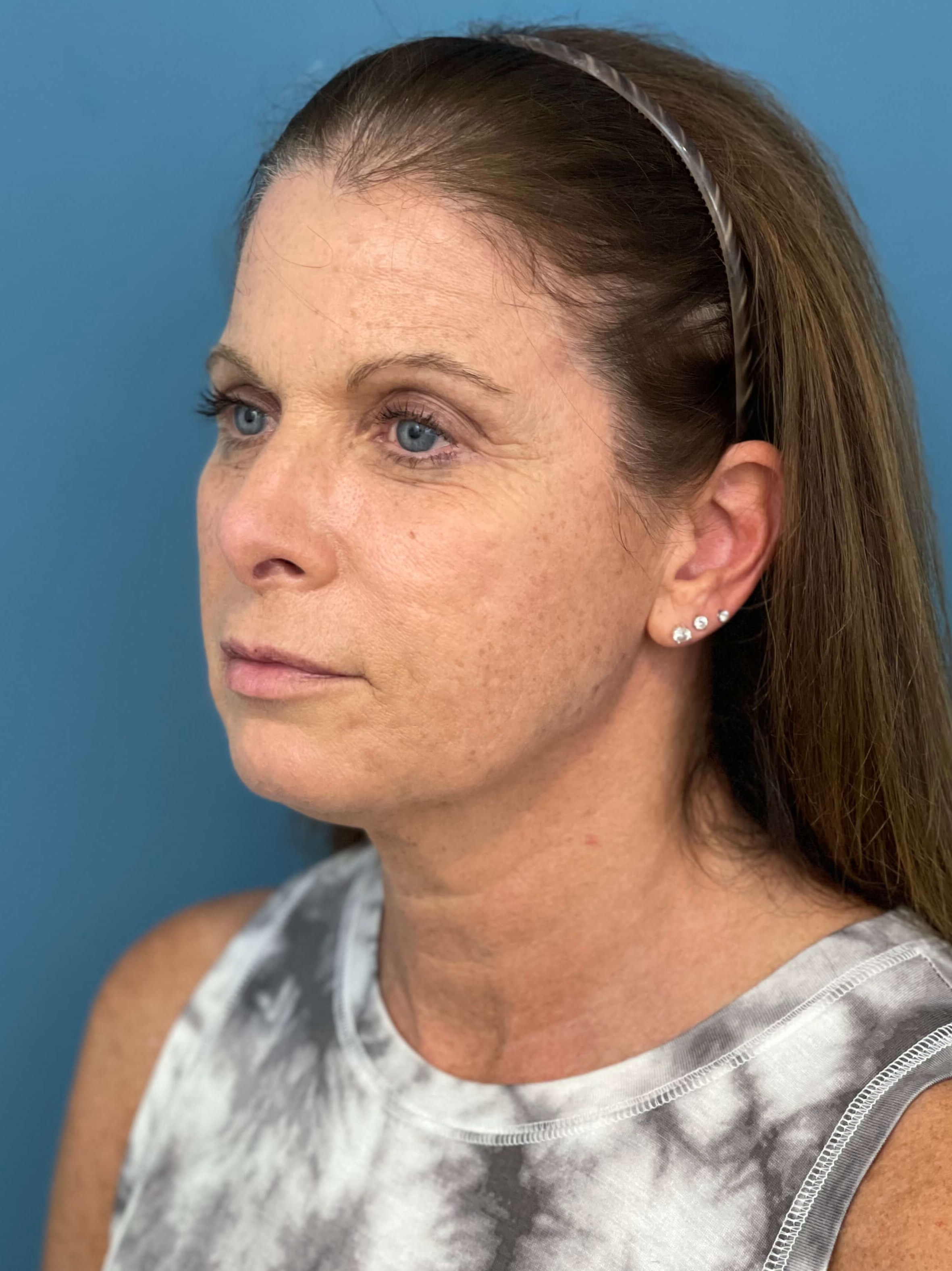 Deep Plane Lower Face and Neck Lift — before, view 4