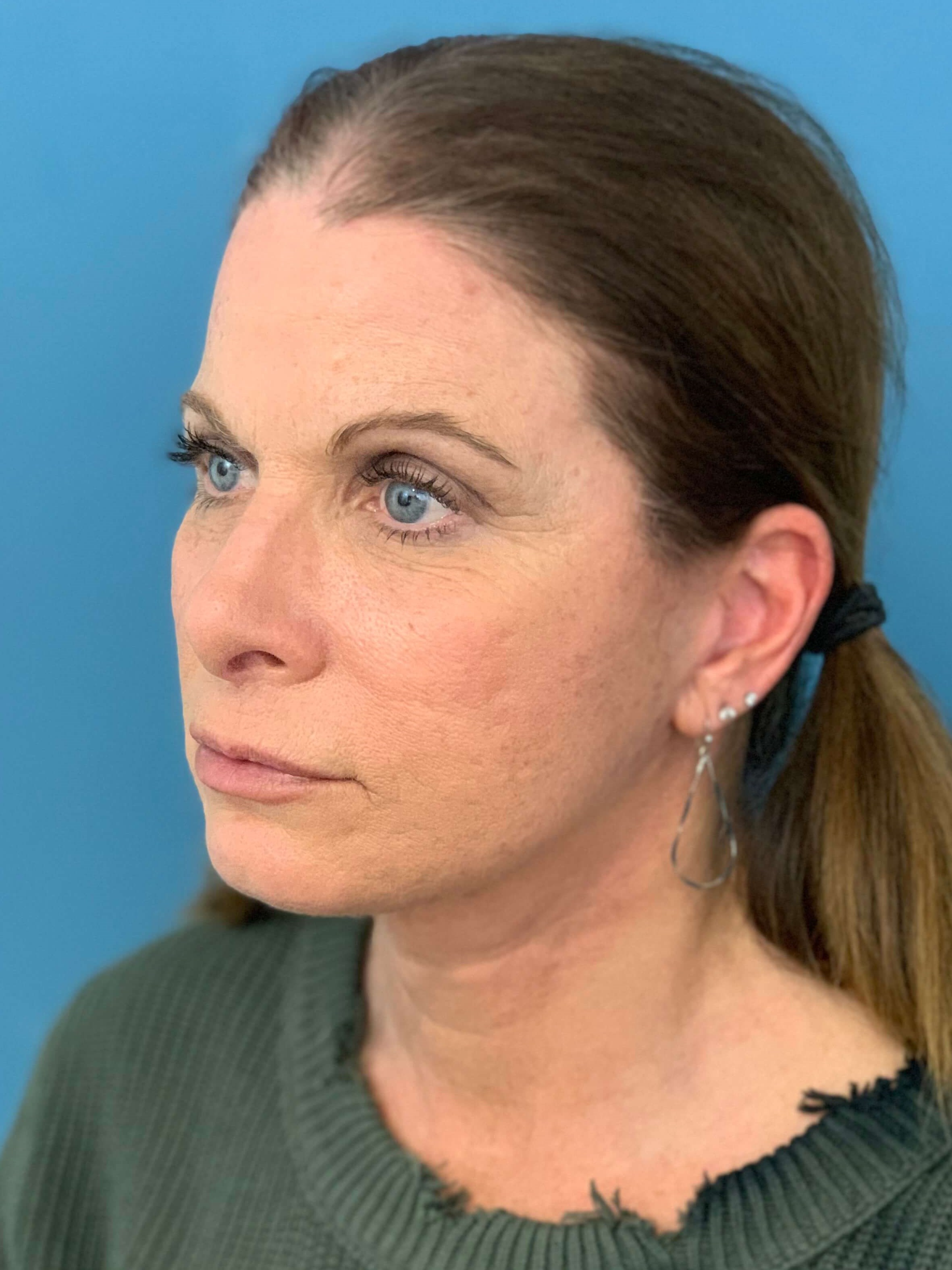 Deep Plane Lower Face and Neck Lift — after, view 4