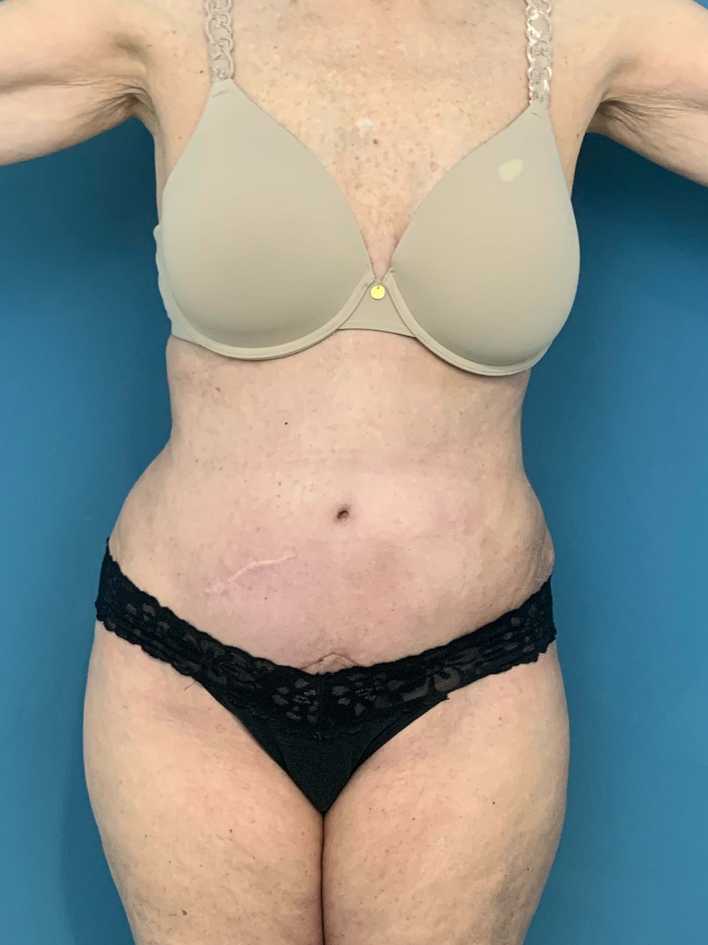 Tummy Tuck and Flank/outer Thigh Liposuction, after, view 1