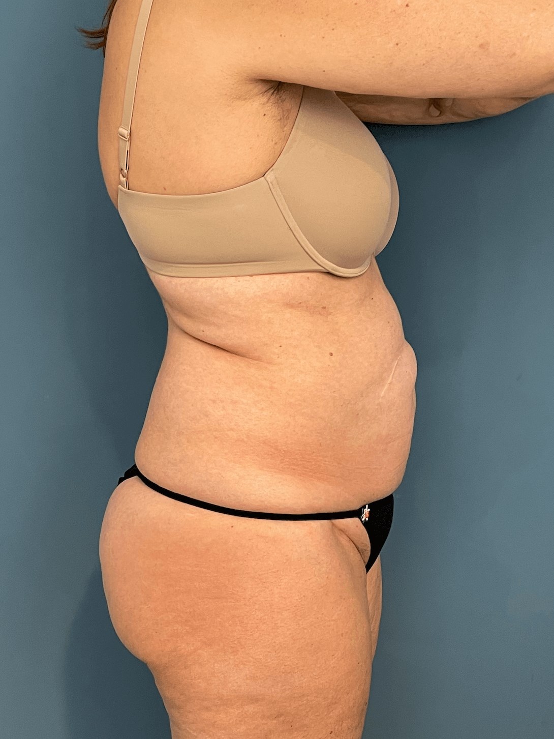 Tummy Tuck and Flank/outer Thigh Liposuction, before, view 2