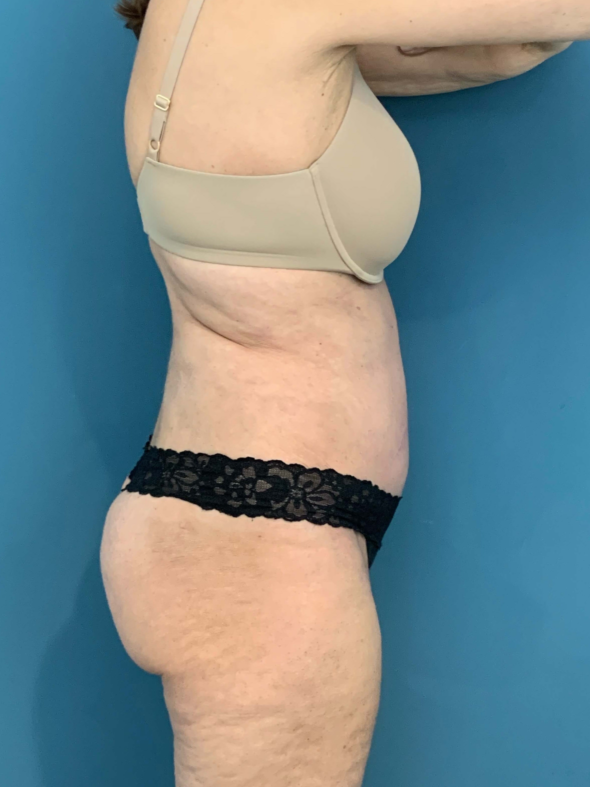 Tummy Tuck and Flank/outer Thigh Liposuction, after, view 2