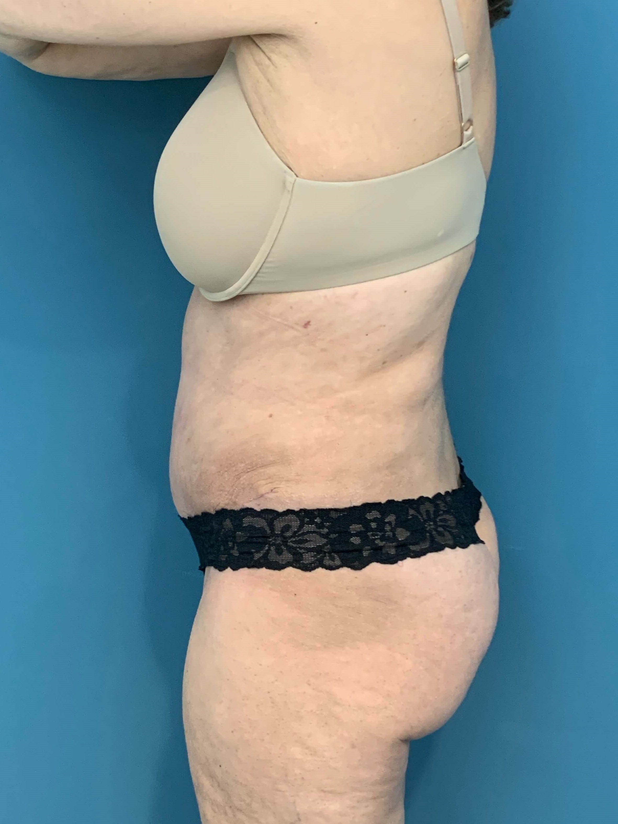 Tummy Tuck and Flank/outer Thigh Liposuction, after, view 3