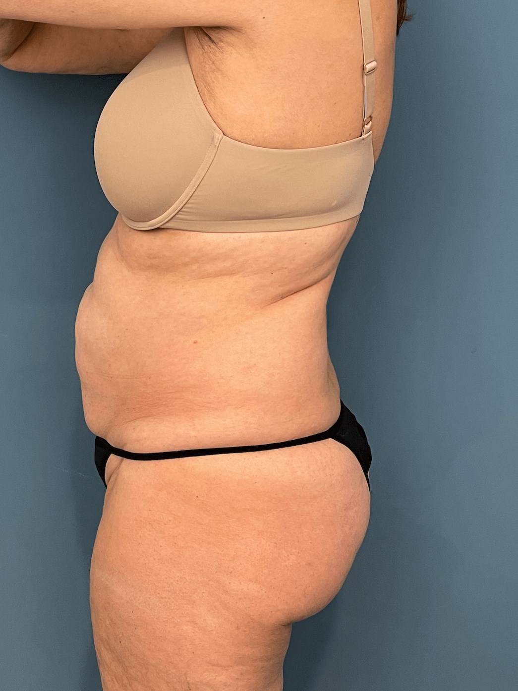 Tummy Tuck and Flank/outer Thigh Liposuction, before, view 3