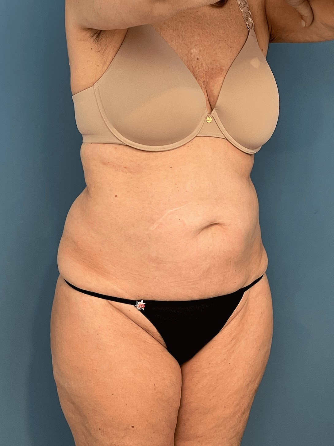 Tummy Tuck and Flank/outer Thigh Liposuction, before, view 4
