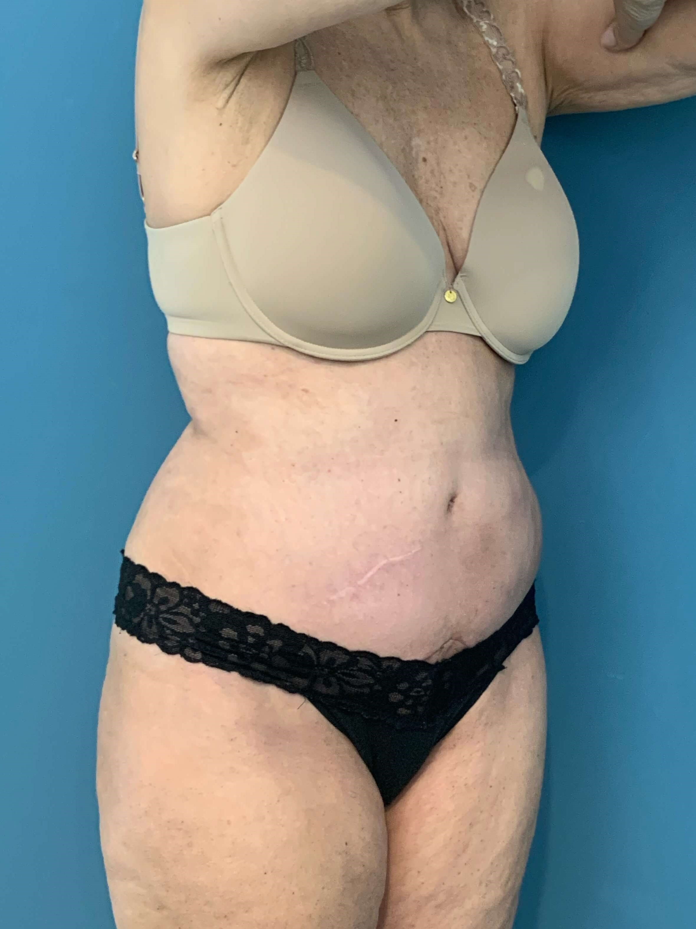 Tummy Tuck and Flank/outer Thigh Liposuction, after, view 4