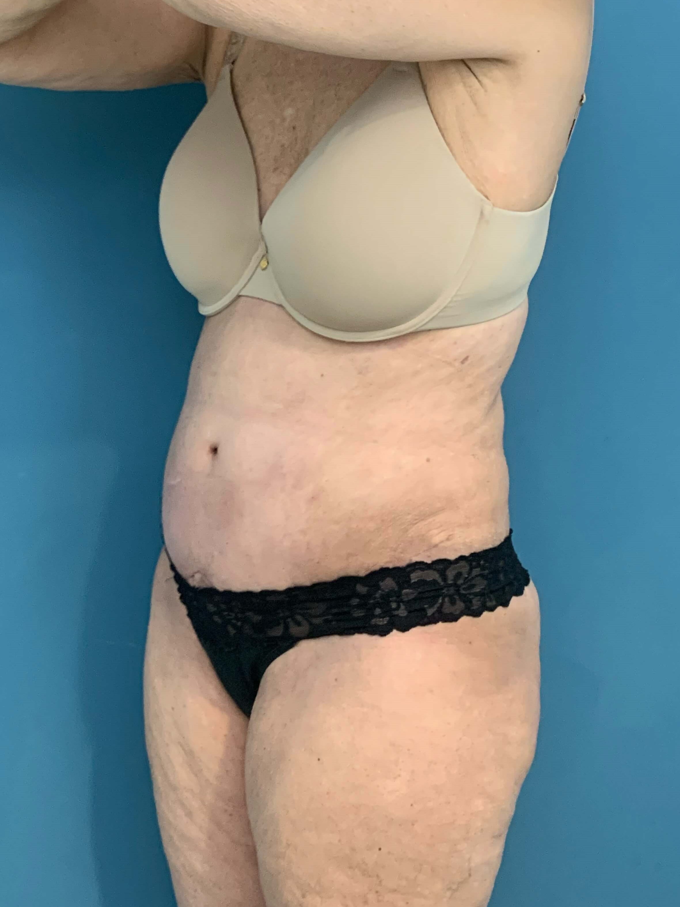 Tummy Tuck and Flank/outer Thigh Liposuction, after, view 5