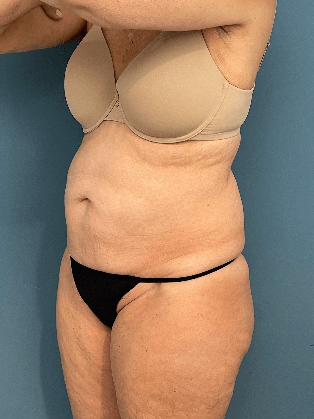 Tummy Tuck and Flank/outer Thigh Liposuction, before, view 5
